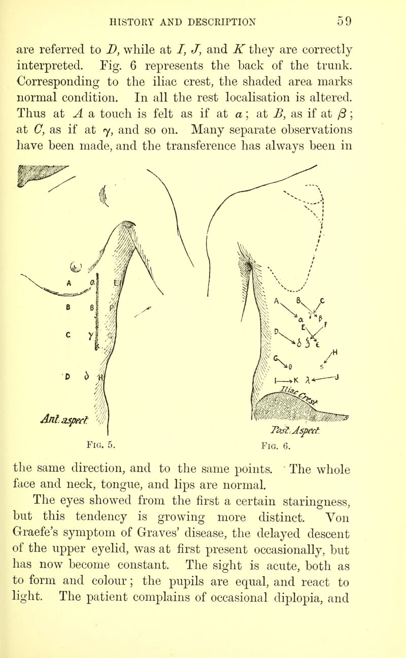 are referred to D, while at /, J, and K they are correctly interpreted. Fig. 6 represents the back of the trunk. Corresponding to the iliac crest, the shaded area marks normal condition. In all the rest localisation is altered. Thus at ^ a touch is felt as if at a; at B, as if at ; at C, as if at 7, and so on. Many separate observations have been made, and the transference has always been in Fig. 5. Fig. 6. the same direction, and to the same points. ' The whole face and neck, tongue, and lips are normal. The eyes showed from the first a certain staringness, but this tendency is growing more distinct. Von Graefe's symptom of Graves' disease, the delayed descent of the upper eyelid, was at first present occasionally, but has now become constant. The sight is acute, both as to form and colour; the pupils are equal, and react to light. The patient complains of occasional diplopia, and