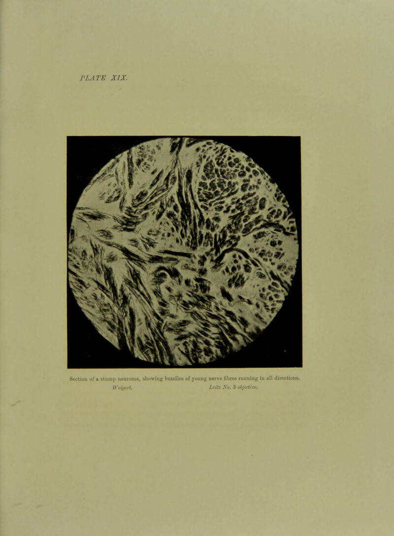 Section of a stiiniii neuroma, showing bundles of j ouug nerve fibres running in all directions. Wciiji-ii. Leit: Xo. Z objective.