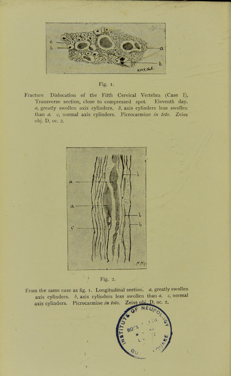 Fig. I. Fracture Dislocation of the Fiftli Cervical Vertebra (Case I). Transverse section, close to compressed spot. Eleventh day. a, greatly swollen axis cylinders. If, axis cylinders less swollen than a. c, normal axis cylinders. Picrocarmine in toto. Zeiss obj. D, oc. 3. Fig. 2. From the same case as fig. i. Longitudinal section'. «, greatly swollen axis cylinders, b, axis cylinders less swollen than a. c, normal axis cylinders. Picrocarmine in toto. Zeis^nhi. D. oc.