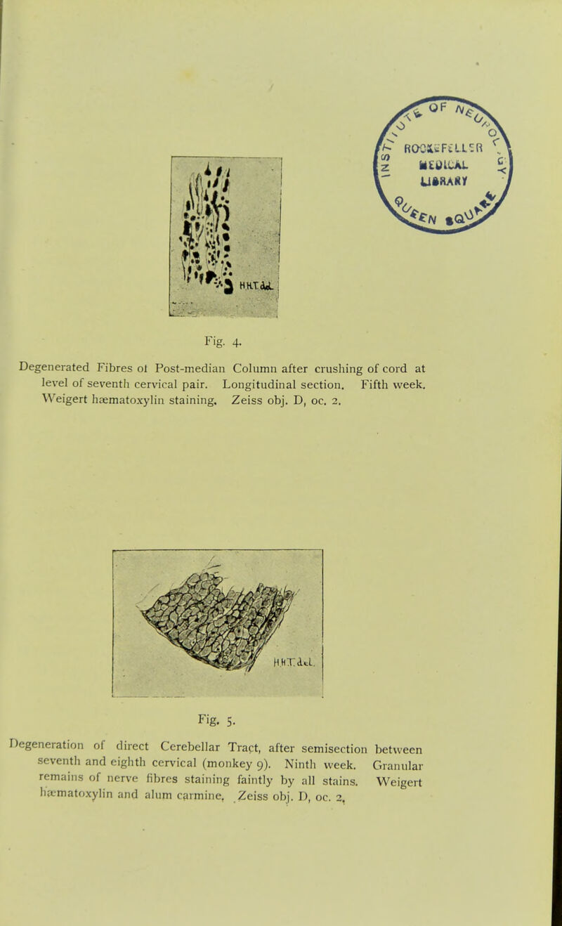 Degenerated Fibres ol Post-median Column after crushing of cord at level of seventh cervical pair. Longitudinal section. Fifth week. Weigert haematoxylin staining. Zeiss obj. D, oc. 2. Fig. 5- Degeneration of direct Cerebellar Tract, after semisection between seventh and eighth cervical (monkey 9). Ninth week. Granular remains of nerve fibres staining faintly by all stains. Weigert hematoxylin and alum carmine, Zeiss obj. D, oc. 2,
