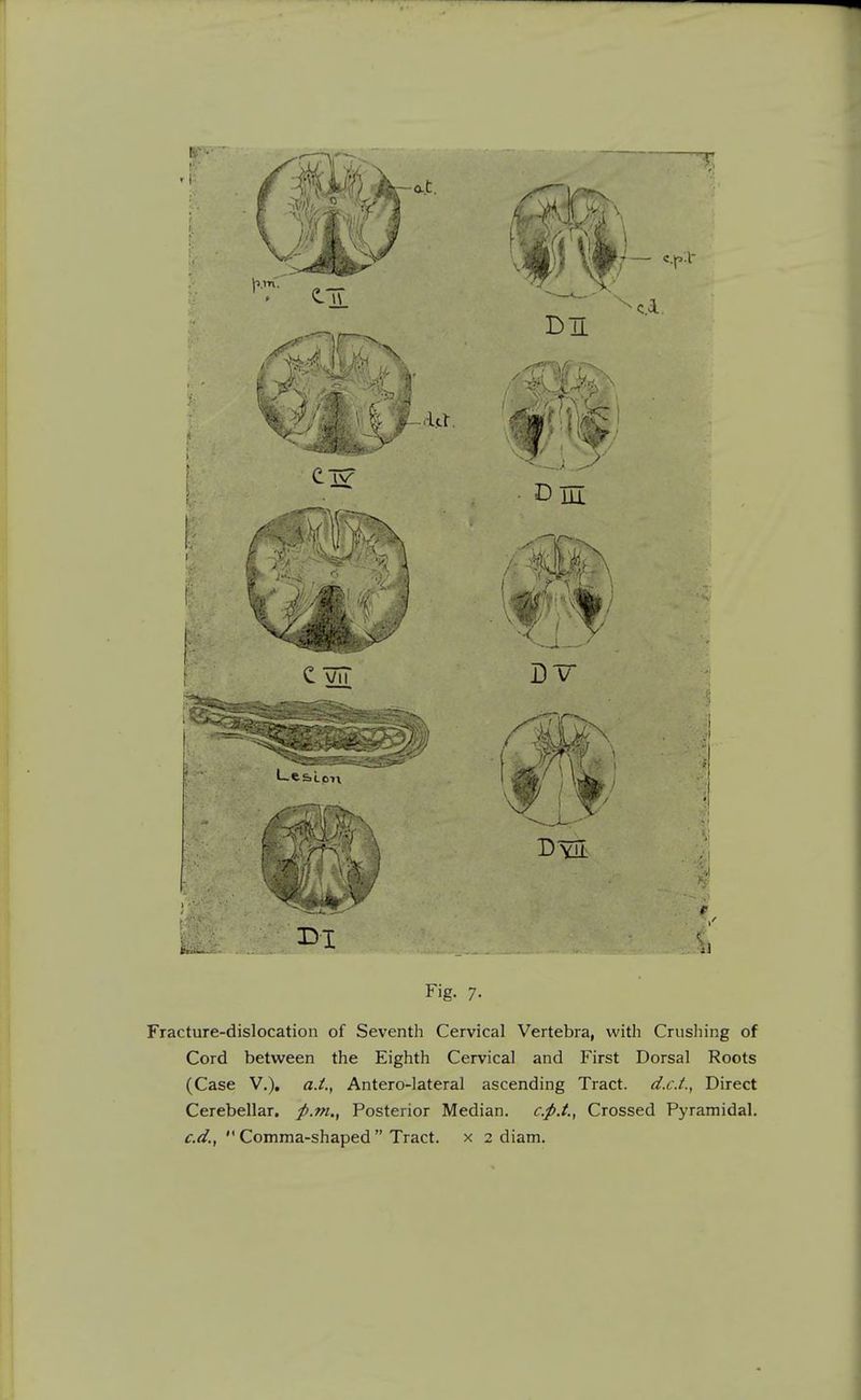 Fracture-dislocation of Seventli Cervical Vertebra, with Crushing of Cord between the Eighth Cervical and First Dorsal Roots (Case v.), a.i., Antero-lateral ascending Tract. d.cJ., Direct Cerebellar, p.m., Posterior Median. c.pX, Crossed Pyramidal. c.d.,  Comma-shaped  Tract, x 2 diam.