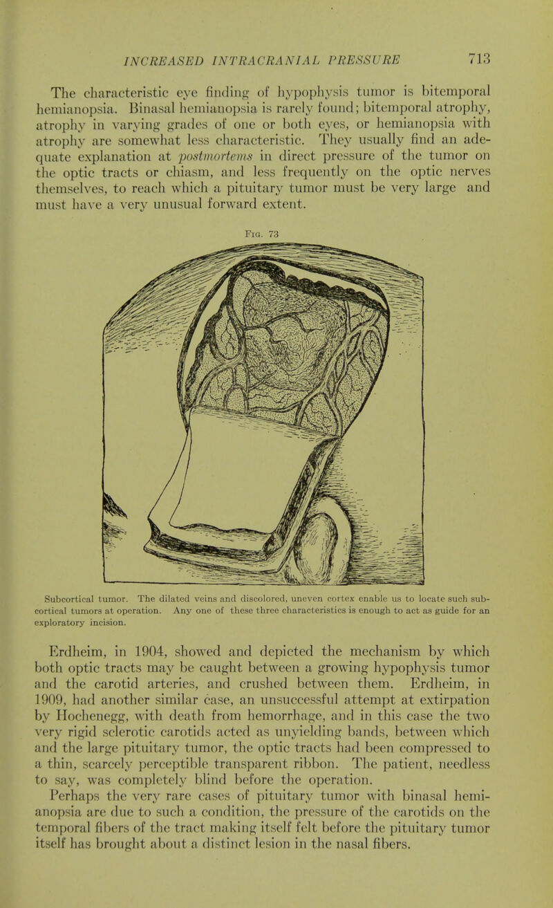 The characteristic eye finding of liypophysis tiunor is bitemporal hemianopsia. Binasal hemianoi)sia is rarely found; bitemporal atrophy, atropliy in varying grades of one or both eyes, or hemianopsia with atrophy are somewhat less characteristic. They usually find an ade- quate explanation at postmortems in direct pressure of the tumor on the optic tracts or chiasm, and less frequently on the optic nerves themselves, to reach which a pituitary tumor must be very large and must ha^'e a very unusual forward extent. Fig. 73 Subcortical tumor. The dilated veins and discolored, uneven cortex enable us to locate such sub- cortical tumors at operation. Any one of these three characteristics is enough to act as guide for an exploratory incision. Erdheim, in 1904, showed and depicted the mechanism by which both optic tracts may be caught between a growing hypophysis tumor and the carotid arteries, and crushed between them. Erdheim, in 1909, had another similar case, an unsuccessful attempt at extirpation by Ilochenegg, with death from hemorrhage, and in this case the two very rigid sclerotic carotids acted as unyielding bands, between which and the large pituitary tumor, the optic tracts had been compressed to a thin, scarcely perceptible transparent ribbon. The patient, needless to say, was completely blind before the operation. Perhaps the very rare cases of pituitary tumor with binasal hemi- anopsia are due to such a condition, the pressure of the carotids on the temporal fibers of the tract making itself felt before the pituitar}' tumor itself has brought about a distinct lesion in the nasal fibers.