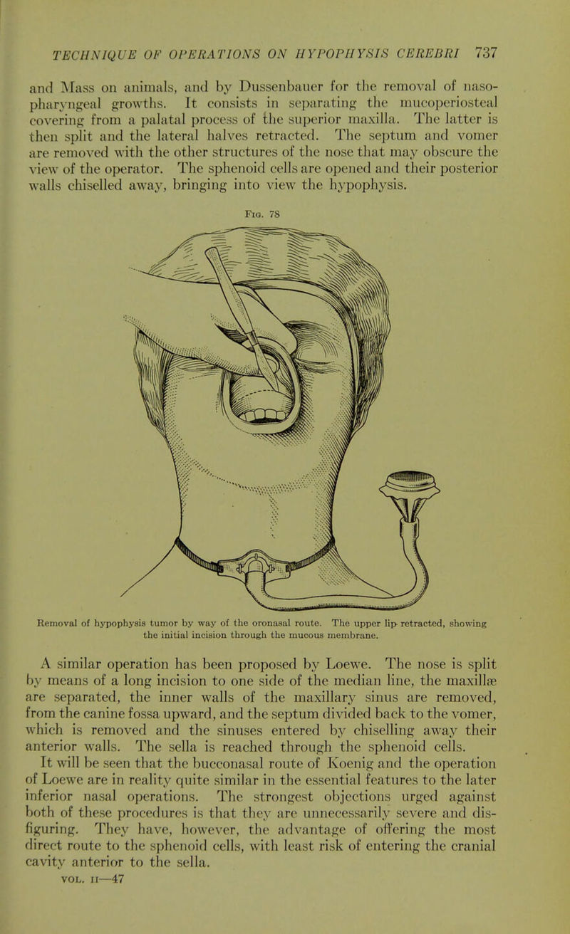 and ]\Iass on animals, and by Dussenbauer for the removal of naso- pharyngeal growths. It consists in separating the mncoperiosteal covering from a palatal process of the snperior maxilla. The latter is then split and the lateral halves retracted. The septum and vomer are removed with the other structures of the nose that may obscure the view of the operator. The sphenoid cells are opened and their posterior walls chiselled away, bringing into view the hypophysis. Fia. 78 Removal of hypophysis tumor by way of the oronasal route. The upper lip- retracted, showing the initial incision through the mucous membrane. A similar operation has been proposed by Loewe. The nose is split by means of a long incision to one side of the median line, the maxillae are separated, the inner walls of the maxillary sinus are removed, from the canine fossa upward, and the septum divided back to the vomer, which is removed and the sinuses entered by chiselling away their anterior walls. The sella is reached through the sphenoid cells. It will be seen that the bucconasal route of Koenig and the operation of Loewe are in reality quite similar in the essential features to the later inferior nasal operations. The strongest objections urged against both of these procedures is that they are unnecessarily severe and dis- figuring. They have, however, the advantage of ofl'ering the most direct route to the sphenoid cells, with least risk of entering the cranial cavity anterior to the sella. VOL. II—47