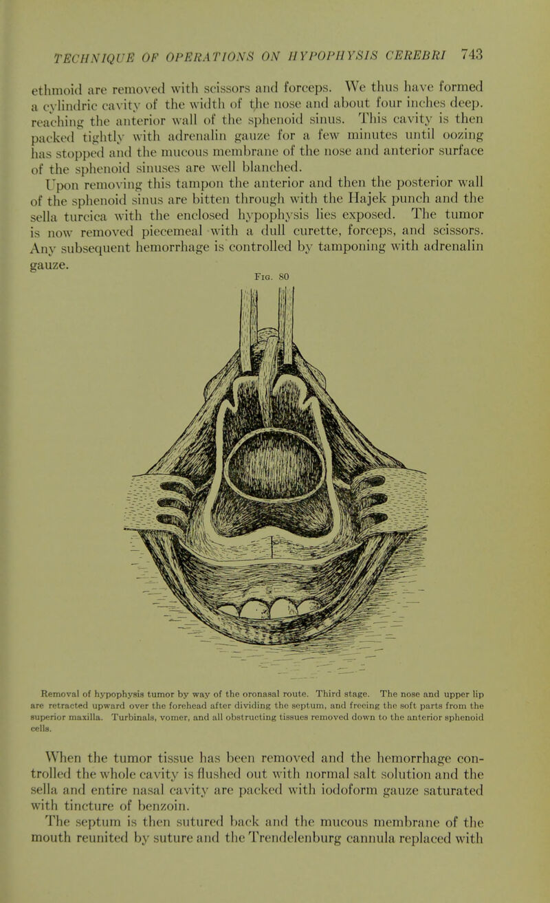 ethmoid are removed with scissors and forceps. We thus have formed a cyHndrie cavity of the width of tjie nose and about four inches deep, reaching the anterior wall of the sphenoid sinus. This cavity is then packet! tightly with adrenalin gauze for a few minutes until oozing has stopped and the mucous membrane of the nose and anterior surface of the splicnoid sinuses are well blanched. Upon removing this tampon the anterior and then the posterior wall of the sphenoid sinus are bitten tlirough with the Hajek punch and the sella turcica with the enclosed hypophysis lies exposed. The tumor is now removed piecemeal with a dull curette, forceps, and scissors. Any subsequent hemorrhage is controlled by tamponing with adrenalin gauze. Fia. 80 Removal of hypophysis tumor by way of the oronasal route. Third stage. The nose and upper lip are retracted upward over the forehead after dividing the septum, and freeing the soft parts from the superior maxilla. Turbinals, vomer, and all obstructing tissues removed down to the anterior sphenoid cells. When the tumor tissue has been removed and the hemorrhage con- trolled the whole cavity is flushed out with normal salt solution and the sella and entire nasal cavity are packed with iodoform gauze saturated with tincture of benzoin. The septum is then sutured back and the mucous membrane of the mouth reunited by suture and the Trendelenburg cannula replaced with