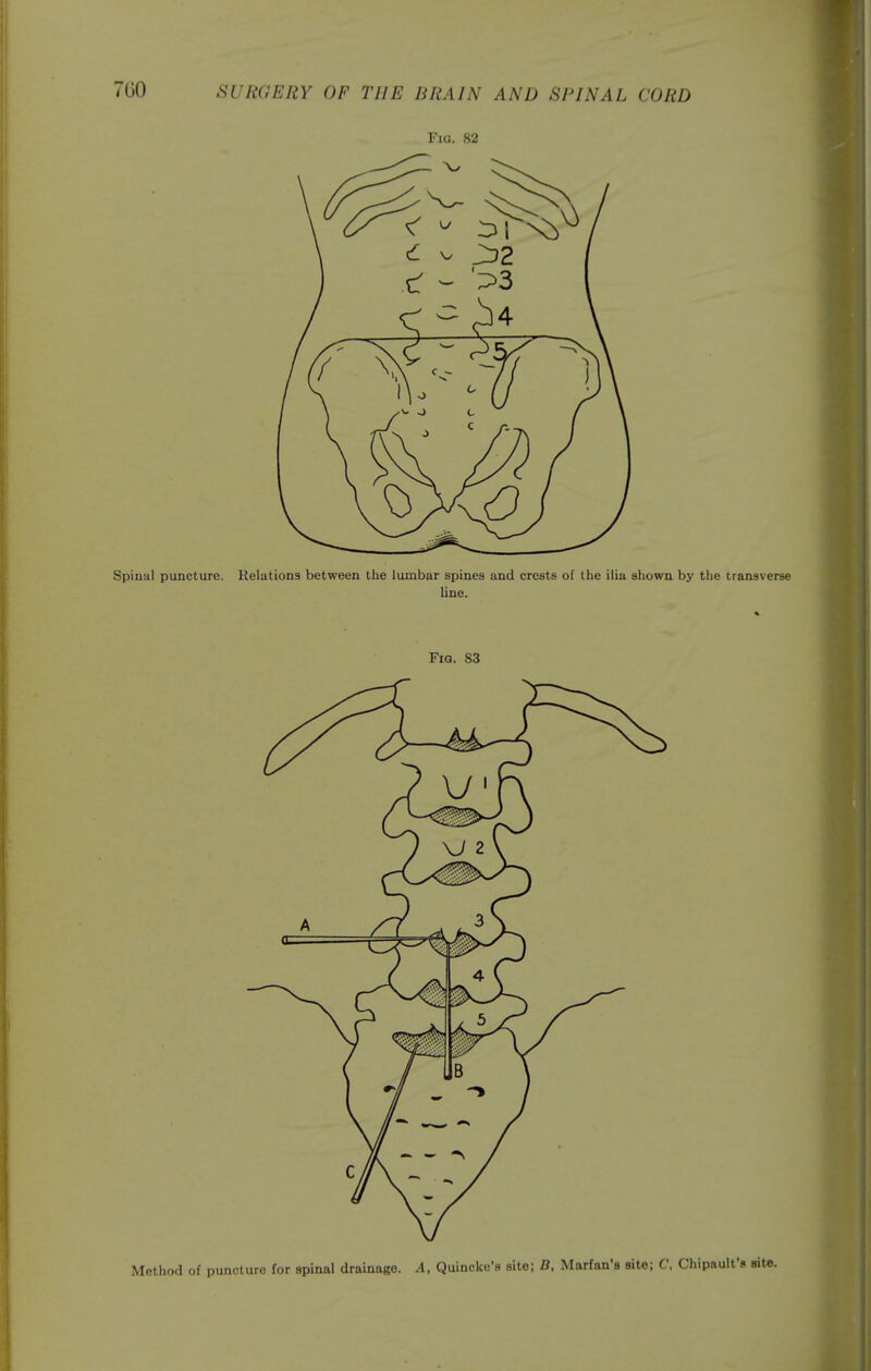 Fig. 82 Spinal puncture. Relations between the lumbar spines and crests of the ilia shown by the transverse line. Fia. 83 Method of puncture for spinal drainage. A, Quincke's site; B, Marfan'a site; C, Chipaulfs