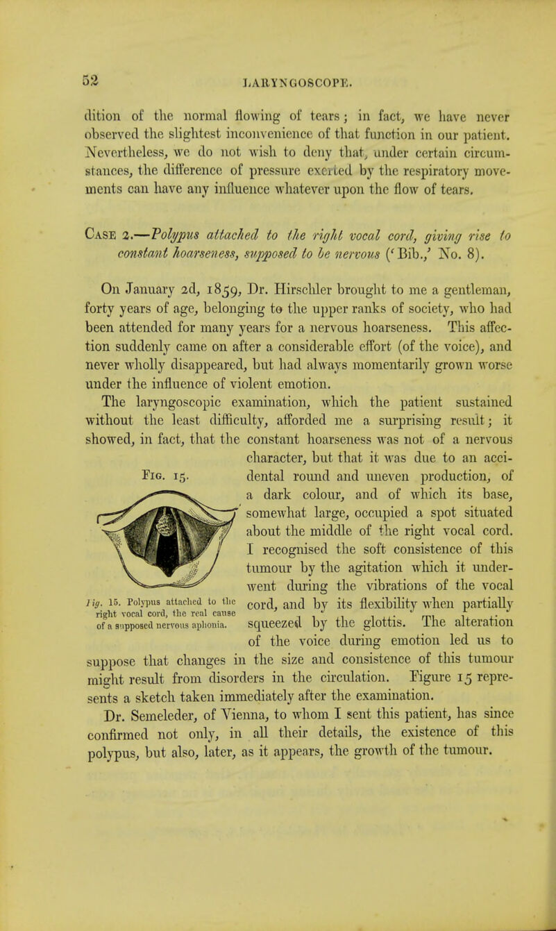 dition of the normal flowing of tears; in fact, we have never observed the slightest inconvenience of that function in our patient. Nevertheless, we do not wish to deny that, under certain circum- stances, the difference of pressure exerted by the respiratory move- ments can have any influence whatever upon the flow of tears. Fig. 15. Case 2.—Polypus attached to the right vocal cord, giving rise to constant hoarseness, supposed to he nervous (' Bib./ No. 8). On January 2d, 1859, Dr. Hirscliler brought to me a gentleman, forty years of age, belonging to the upper ranks of society, who had been attended for many years for a nervous hoarseness. This affec- tion suddenly came on after a considerable effort (of the voice), and never wholly disappeared, but had always momentarily grown worse under the influence of violent emotion. The laryngoscopic examination, which the patient sustained without the least difficulty, afforded me a surprising result; it showed, in fact, that the constant hoarseness was not of a nervous character, but that it was due to an acci- dental round and uneven production, of a dark colour, and of which its base, somewhat large, occupied a spot situated about the middle of the right vocal cord. I recognised the soft consistence of this tumour by the agitation w hich it under- went during the vibrations of the vocal cord, and by its flexibility when partially squeezed, by the glottis. The alteration of the voice during emotion led us to suppose that changes in the size and consistence of this tumour might result from disorders in the circulation. Figure 15 repre- sents a sketch taken immediately after the examination. Dr. Seineleder, of Vienna, to whom I sent this patient, has since confirmed not only, in all their details, the existence of this polypus, but also, later, as it appears, the growth of the tumour. Jig. 15. Polypus attached to tlic right vocal cord, the real cause of a supposed nervous aphonia.