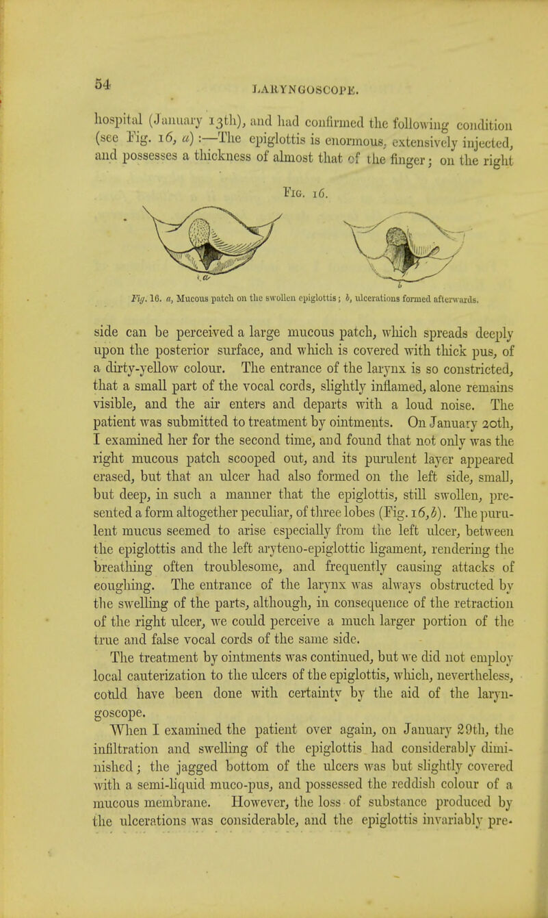 LARYNGOSCOPE. hospital (January 13th), and had confirmed the following condition (see Kg. 16, a) :—The epiglottis is enormous, extensively injected, and possesses a thickness of almost that of the finger; on the right Fig. 16. Fig. 16. «, Mucous patch on the swollen epiglottis; b, ulcerations formed afterwards. side can be perceived a large mucous patch, winch spreads deeply upon the posterior surface, and which is covered with thick pus, of a dirty-yellow colour. The entrance of the larynx is so constricted, that a small part of the vocal cords, slightly inflamed, alone remains visible, and the air enters and departs with a loud noise. The patient was submitted to treatment by ointments. On January 20th, I examined her for the second time, and found that not onlv was the right mucous patch scooped out, and its purulent layer appeared erased, but that an ulcer had also formed on the left side, small, but deep, in such a manner that the epiglottis, still swollen, pre- sented a form altogether peculiar, of three lobes (Fig. 16, h). The puru- lent mucus seemed to arise especially from the left ulcer, between the epiglottis and the left aryteno-epiglottic ligament, rendering the breathing often troublesome, and frequently causing attacks of coughing. The entrance of the larynx was always obstructed by the swelling of the parts, although, in consequence of the retraction of the right ulcer, we could perceive a much larger portion of the true and false vocal cords of the same side. The treatment by ointments was continued, but we did not employ local cauterization to the ulcers of the epiglottis, which, nevertheless, cotdd have been done with certainty by the aid of the laryn- goscope. When I examined the patient over again, on January 29th, the infiltration and swelling of the epiglottis had considerably dimi- nished ; the jagged bottom of the ulcers was but slightly covered with a semi-liquid muco-pus, and possessed the reddish colour of a mucous membrane. However, the loss of substance produced by the ulcerations was considerable, and the epiglottis invariably pre-