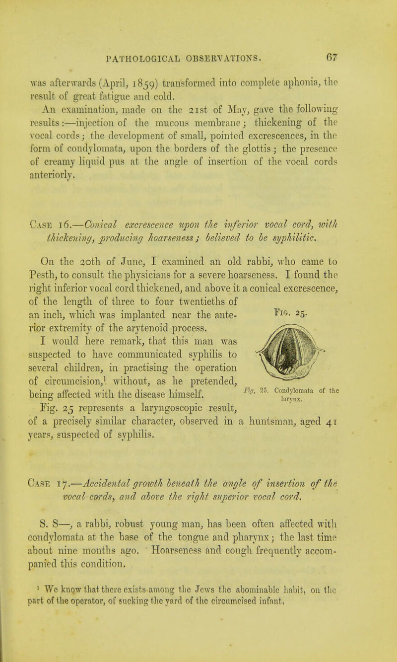 was afterwards (April, 1859) transformed into complete aphonia, the result of great fatigue and cold. An examination, made on the 21st of May, gave the following results :—injection of the mucous membrane; thickening of the vocal cords; the development of small, pointed excrescences, in the form of condylomata, upon the borders of the glottis; the presence of creamy liquid pus at the angle of insertion of the vocal cords anteriorly. Case 16.—Conical excrescence upon the inferior vocal cord, with thickening, producing hoarseness; believed to he syphilitic. On the 20th of June, I examined an old rabbi, who came to Pesthj to consult the physicians for a severe hoarseness. I found the right inferior vocal cord thickened, and above it a conical excrescence, of the length of three to four twentieths of an inch, which was implanted near the ante- rior extremity of the arytenoid process. I would here remark, that this man was suspected to have communicated syphilis to several children, in practising the operation of circumcision,1 without, as he pretended, Fig. 25. being affected with the disease himself. Fir;. 25. Condylomata of the larynx. Pig. 25 represents a laryngoscopy result, of a precisely similar character, observed in a huntsman, aged 41 years, suspected of syphilis. Case tj.—Accidental growth beneath the angle of insertion of the vocal cords, and above the right superior vocal cord. 8. S—, a rabbi, robust young man, has been often affected with condylomata at the base of the tongue and pharynx; the last time about nine months ago. Hoarseness and cough frequently accom- panied this condition. 1 We know that there exists among the Jews the abominable habit, on the part of the operator, of sucking the yard of the circumcised infant,