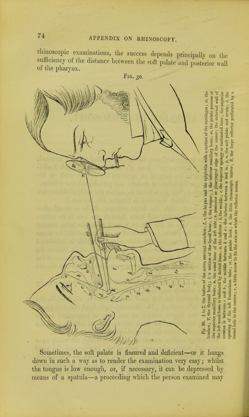 APPENDIX ON RHINOSCOPY. rhinoscopic examinations, the success depends principally on the sufficiency of the distance between the soft palate and posterior wall of the pharynx. Fig. 30. Sometimes, the soft palate is fissured and deficient—or it hangs down in such a way as to render the examination very easy; whilst the tongue is low enough, or, if necessary, it can be depressed by means of a spatula—a proceeding which the person examined may