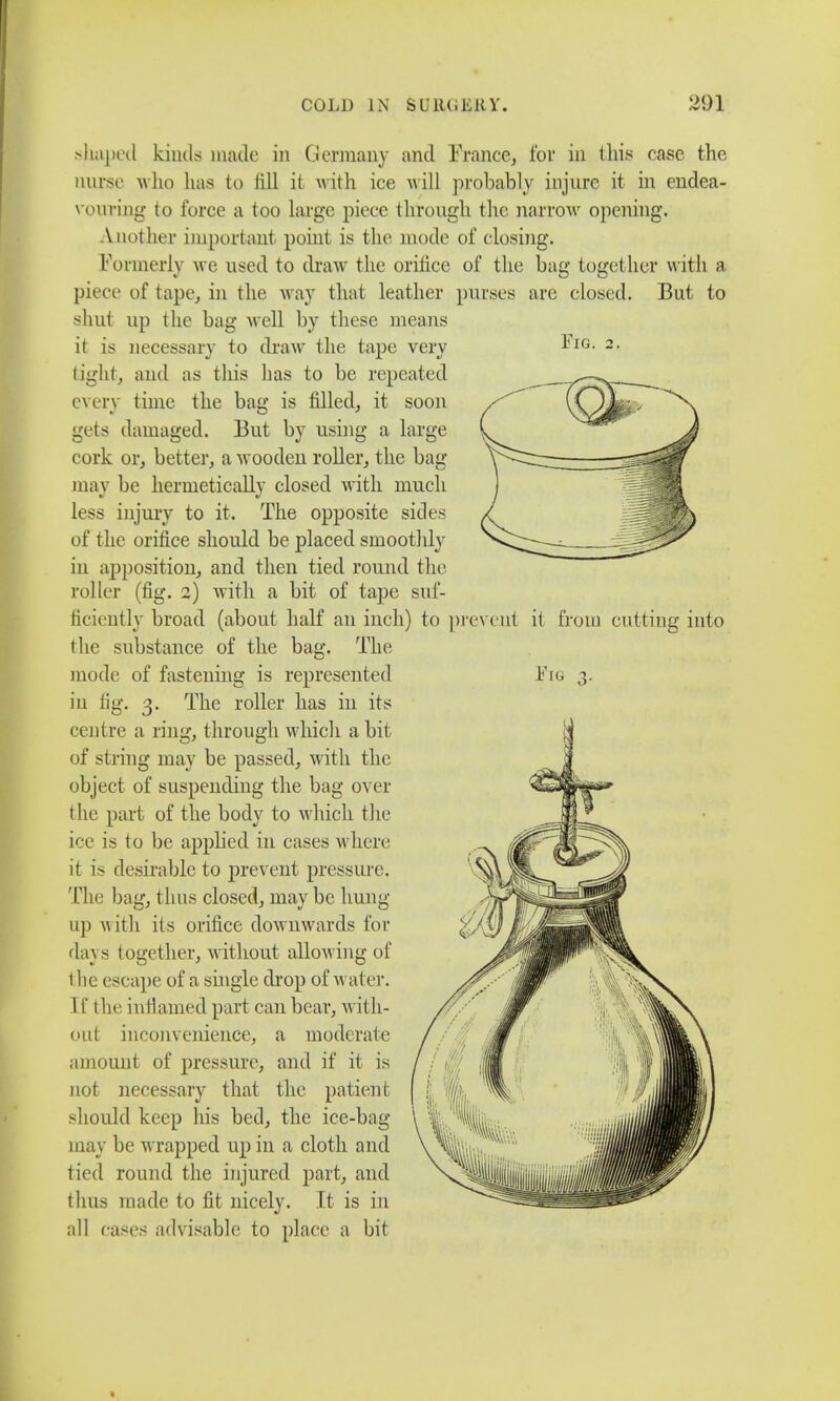 Fig. 2. Yin shaped kinds made in Germany and France, for in this case the nurse who lias to fill it with ice will probably injure it in endea- vouring to force a too large piece through the narrow opening. Another important point is the mode of closing. Formerly we used to draw the orifice of the bag together with a piece of tape, in the way that leather purses arc closed. But to shut up the bag well by these means it is necessary to draw the tape very light, and as this has to be repeated every time the bag is tilled, it soon gets damaged. But by using a large cork or, better, a wooden roller, the bag may be hermetically closed with much less injury to it. The opposite sides of the orifice should be placed smoothly in apposition, and then tied round the roller (fig. 2) with a bit of tape suf- ficiently broad (about half an inch) to prevent it from cutting into the substance of the bag. The mode of fastening is represented in fig. 3. The roller has in its centre a ring, through which a bit of string may be passed, with the object of suspending the bag over the part of the body to which the ice is to be applied in cases where it is desirable to prevent pressure. The bag, thus closed, may be hung up with its orifice downwards for days together, without allowing of 1 lie escape of a single drop of water. I f 1 he inflamed part can bear, with- out inconvenience, a moderate amount of pressure, and if it is not necessary that the patient should keep his bed, the ice-bag may be wrapped up in a cloth and tied round the injured part, and thus made to fit nicely. It is in all cases advisable to place a bit