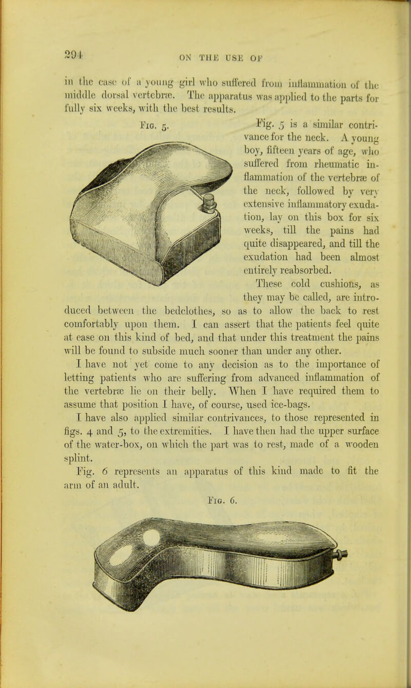 291 in the case of a young girl who suffered from inllaimnation oi* the middle dorsal vertebne. The apparatus was applied to the parts for Fully six weeks, with the besl results. Fig. 5. Fig- .5 is a similar contri- vance for the neck. A young boy, fifteen years of age, who suffered from rheumatic in- flammation of the vertebrae of the neck, followed by very extensive inflammatory exuda- tion, lay on this box for six weeks, till the pains had quite disappeared, and till the exudation had been almost entirely reabsorbed. These cold cushions, as they may be called, are intro- duced between the bedclothes, so as to allow the back to rest comfortably upon them. I can assert that the patients feel quite at ease on this kind of bed, and that under this treatment the pains will be found to subside much sooner than under any other. I have not yet come to any decision as to the importance of letting patients who are suffering from advanced inflammation of the vertebras lie on their belly. When I have required them to assume that position I have, of course, used ice-bags. I have also applied similar contrivances, to those represented in figs. 4 and 5, to the extremities. I have then had the upper surface of the water-box, on which the part was to rest, made of a wooden splint. Fig. 6 represents an apparatus of this kind made to fit the arm of an adult.