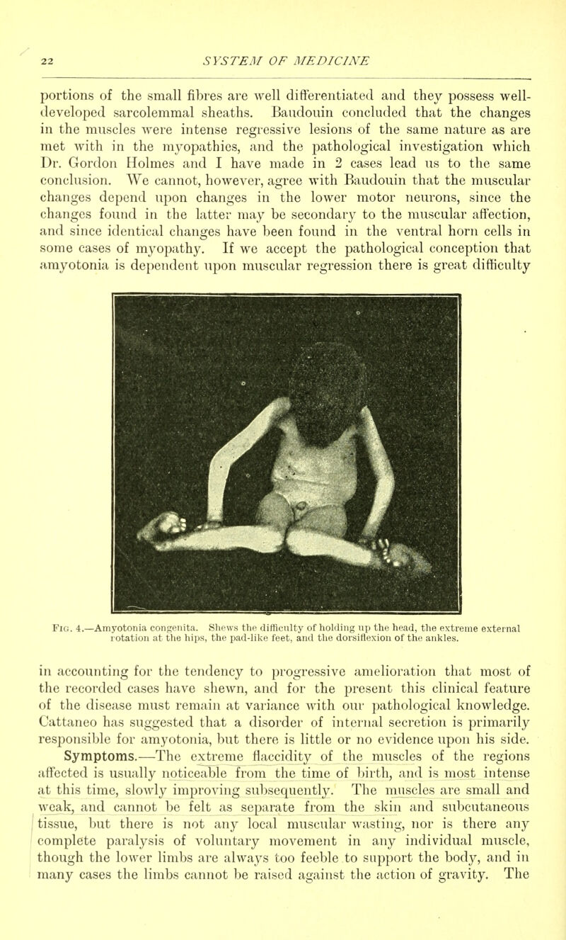 portions of the small fibres are well differentiated and they possess well- developed sarcolemmal sheaths. Baudouin concluded that the changes in the muscles were intense regressive lesions of the same nature as are met with in the myopathies, and the pathological investigation which Dr. Gordon Holmes and I have made in 2 cases lead us to the same conclusion. We cannot, however, agree with Baudouin that the muscular changes depend upon changes in the lower motor neurons, since the changes found in the latter may be secondary to the muscular affection, and since identical changes have been found in the ventral horn cells in some cases of myopathy. If we accept the pathological conception that amyotonia is dependent upon muscular regression there is great difficulty Fig. 4.—Amyotonia congenita. Shews tlie difficulty of holding up the head, the extreme external rotation at the hips, the pad-like feet, and the dorsiflexion of the ankles. in accounting for the tendency to progressive amelioration that most of the recorded cases have shewn, and for the present this clinical feature of the disease must remain at variance with our pathological knowledge. Cattaneo has suggested that a disorder of internal secretion is primarily responsible for amyotonia, but there is little or no evidence upon his side. Symptoms.—The extreme flaccidity of the muscles of the regions affected is usually noticeable from the time of birth, and is most intense at this time, slowly improving subsequently. The muscles are small and weak, and cannot be felt as separate from the skin and subcutaneous tissue, but there is not any local muscular wasting, nor is there any complete paralysis of voluntary movement in any individual muscle, though the lower limbs are always too feeble to support the body, and in many cases the limbs cannot be raised against the action of gravity. The