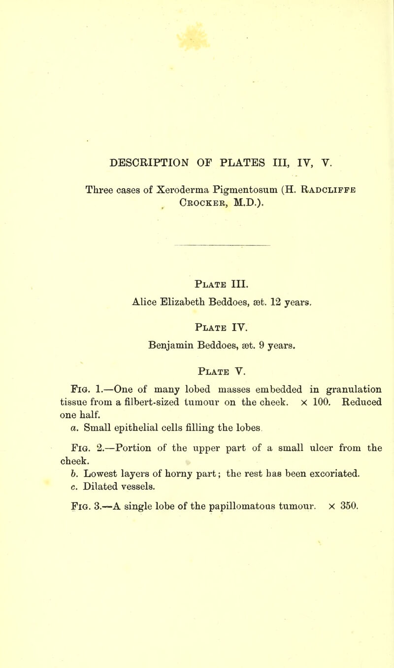 Three cases of Xeroderma Pigmentosum (H. Radcliffe Crocker, M.D.). Plate III. Alice Elizabeth Beddoes, set. 12 years, Plate IV. Benjamin Beddoes, set. 9 years. Plate V. Fig. 1.—One of many lobed masses embedded in granulation tissue from a filbert-sized tumour on the cheek, x 100. Reduced one half. a. Small epithelial cells filling the lobes Fig. 2.—Portion of the upper part of a small ulcer from the cheek. b. Lowest layers of horny part; the rest has been excoriated. c. Dilated vessels. Fig. 3.—A single lobe of the papillomatous tumour, x 350.