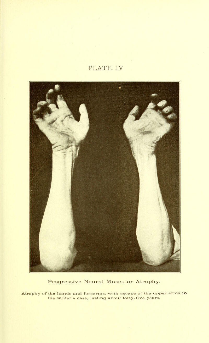 Progressive Neural Muscular Atrophy. Atrophy of the hands and forearms, with escape of the upper arms in the writer's case, lasting about forty-live years.