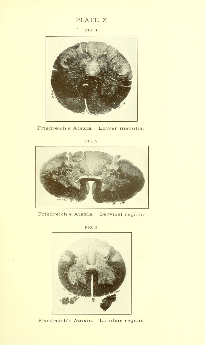 FIG. 1 Friedreich's Ataxia. Lower medulla. FIG. 2 Friedreich's Ataxia. Cervical region. FIG. 3 Friedreich's Ataxia. Lumbar region.