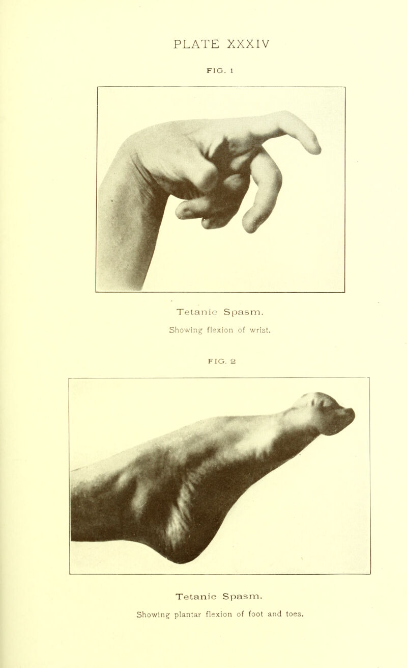 FIG. 1 Tetanic Spasm. Showing plantar flexion of foot and toes.
