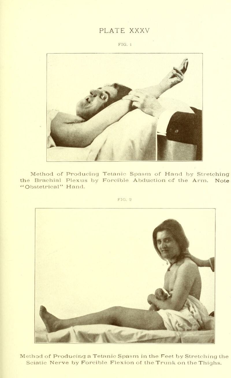 FIG. 1 Method of Producing Tetanic Spasm of Hand by Stretching the Brachial Plexus by Forcible Abduction of the Arm. Note Obstetrical Hand. FIG. 2 Method of Producing a Tetanic Spasm in the Feet by Stretching the Sciatic Nerve by Forcible Flexion of the Trunk on the Thighs.