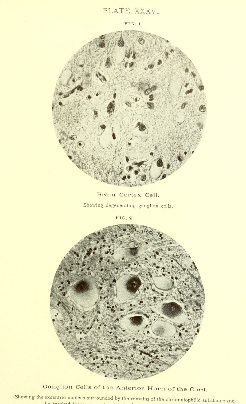 FIO. 1 i l Brain Cortex Cell. Showing degenerating ganglion cells. FIG. 2 Ganglion Cells of the Anterior Horn of the Cord. Showing the excentric nucleus surrounded by the remains of the chromatophilic substance and