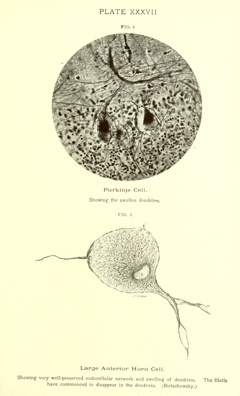 FIG. 1 Purkinje Cell. Showing the swollen dendrites. FIG. 2 Large Anterior Horn Cell. Showing very well-preserved endocellular network and swelling of dendrites. The fibrils have commenced to disappear in the dendrites. (Bielschowsky.)