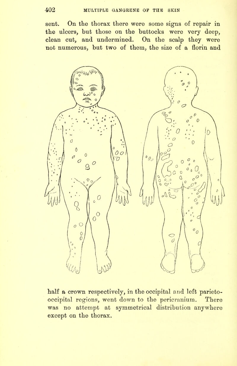 sent. On the thorax there were some signs of repair in the ulcerSj but those on the buttocks were very deep, clean cut, and undermined. On the scalp they were not numerous, but two of them, the size of a florin and half a crown respectively, in the occipital and left parieto- occipital regions, went down to the pericranium. There was no attempt at symmetrical distribution anywhere except on the thorax.