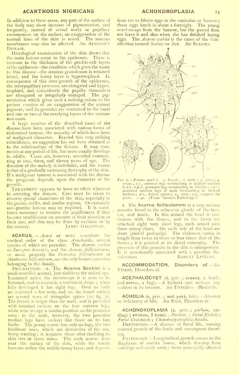 In addition to these areas, any part of the surface of the body may show increase of pigmentation, and frequently, instead of actual warty or papillary excrescences on the surface, an exaggeration of the normal lines of the skin is noted. The mucous membranes may also be affected. See Addison's Disease. Histological examination of the skin shows that the main lesions occur in the epidermis. There is increase in the thickness of the prickle-cell layers of the epidermis—the condition which gives the name to this disease—the stratum granulosum is retained intact, and the horny layer is hypertrophied. In consequence of this over-growth of the epidermis, the interpapillary processes are elongated and hyper- trophied, and coincidently the papillx- themselves are elongated or irregularly enlarged. The pig- mentation which gives such a striking colour to the patient consists of an exaggeration of the normal pigment, and its granules are contained in the basal and one or two of the overlying layers of the stratum mucosura. A large number of the described cases of the disease have been associated with various forms of abdominal tumour, the majority of which have been of mahgnant character. Beyond this very striking coincidence, no suggestion has yet been obtained as to the relationships of the disease. It may com- mence at any period of life, but more usually develops in adults. Cases are, however, recorded commen- cing at two, three, and eleven years of age. The duration of the malady is indefinite, and the course is that of a gradually increasing dystrophy of the skin. If a malignant tumour is associated with the disease the prognosis depends upon the character of the growth. Tre.\TMENT appears to have no effect whatever in arresting the disease. Care must be taken to observe special cleanliness of the skin, especially in the groins, axillae, and similar regions. Occasionally anti-pruritic lotions may be required. It is some- times necessary to remove the papillomata if they become troublesome on account ol their situation or their size, and this may be done by excision or by the cautery. James Galloway. ACARUS.—Acaii or inites constitute the tracheal order of the class Arachnida, several species of which are parasitic. The A car us srabiei or Sarcoptes hoininis, and the Acarits follictdorittn, or more properly the Dcnwdex foUicidonim or Steatozooit folliLiiloriini, are the only human parasites belonging to this family. Description.—i. The Acarus Scabiei is a small roundish animal, just visible to the naked eye. Examined under the microscope it is seen to be flattened, and to resemble a tortoise in shape ; when fully developed it has eight leg.-. Over its body are scattered a few setae, and on the dorsal surface are several rows of triangular spines {sec fig. l). The female is larger than the male, and is provided with terminal suckers on the four anterior legs, while setae occupy a similar position on the posterior ones: in the male, however, the two posterior median legs have suckers like those on its fore limbs. The yoimg acarus has only six legs, the two hindmost ones, which are distinctive of the sex, being wanting ; it acquires these after shedding its skin two or three times. The male acarus lives near the surface of the skin, while the female burrows within the middle horny layer, and deposits from ten to fifteen eggs in the cuniculus or burrow \ these eggs hatch in about a fortnight. The young acari escape from the burrow, but the parent does not leave it and dies when she has finished laying eggs. The Acarus scahiet'n the cause of the skin- aftection termed Scabies or Itch. See Scakies. Fig I.—Acn7tts scahici. i, female; 2, male; 3, larva; 4, ovuni ; a.L, anterior legb terminating in stalked suckers (s.j.) : e.pj,, posterior legs terminating in bristles ; i.p.L, posterior median legs of male terminating in stalked suckers; dorsal spines; f., setae; i./., support for penis. X 90. (From  Green's Pathology.) 2. The Acarus folliculorum is a very minute parasite found in the sebaceous glands of the face, ear, and trunk. In this animal the head is con- tinuous with the thorax, and to the latter are attached eight very short legs, each armed with three strong claws. On each side of the head are short jointed pedopalpi. The abdomen varies in length from twice to three or four limes that of the thorax ; it is pointed at its distal extremity. The presence of this parasite in the skin is unimportant. It is occasionally associated with a peculiar dis- coloration. Robert Liveing. ACCOMMODATION, Disorders o^.Sec Vision, Disorders of. ACEPHALOCYST (a, priv. ; Ke(pa\r}. a head ; and/ciicTTis, a bag).—A hydatid cyst without any scolices in its interior. See Entozoa -Hydatids. ACHOLIA (a, priv. ; and x^^, hile).—Absence or deficiency of bile. See Bile, Disorders of. ACHONDROPLASIA (a, priv. ; xocSpoj, car- tilage ; irXdaaic, I form).—Synon. : Fatal Rickets ; Fatal Cretinism ; Chondrodystrophia fatalis. Definition.—A disease of foetal life, causing stunted growth of the limbs and consequent dwarf- ing- Pathology.—Longitudinal growth ceases in the diaphyses of certain bones, which develop from cartilage and ossify early : those principally affected
