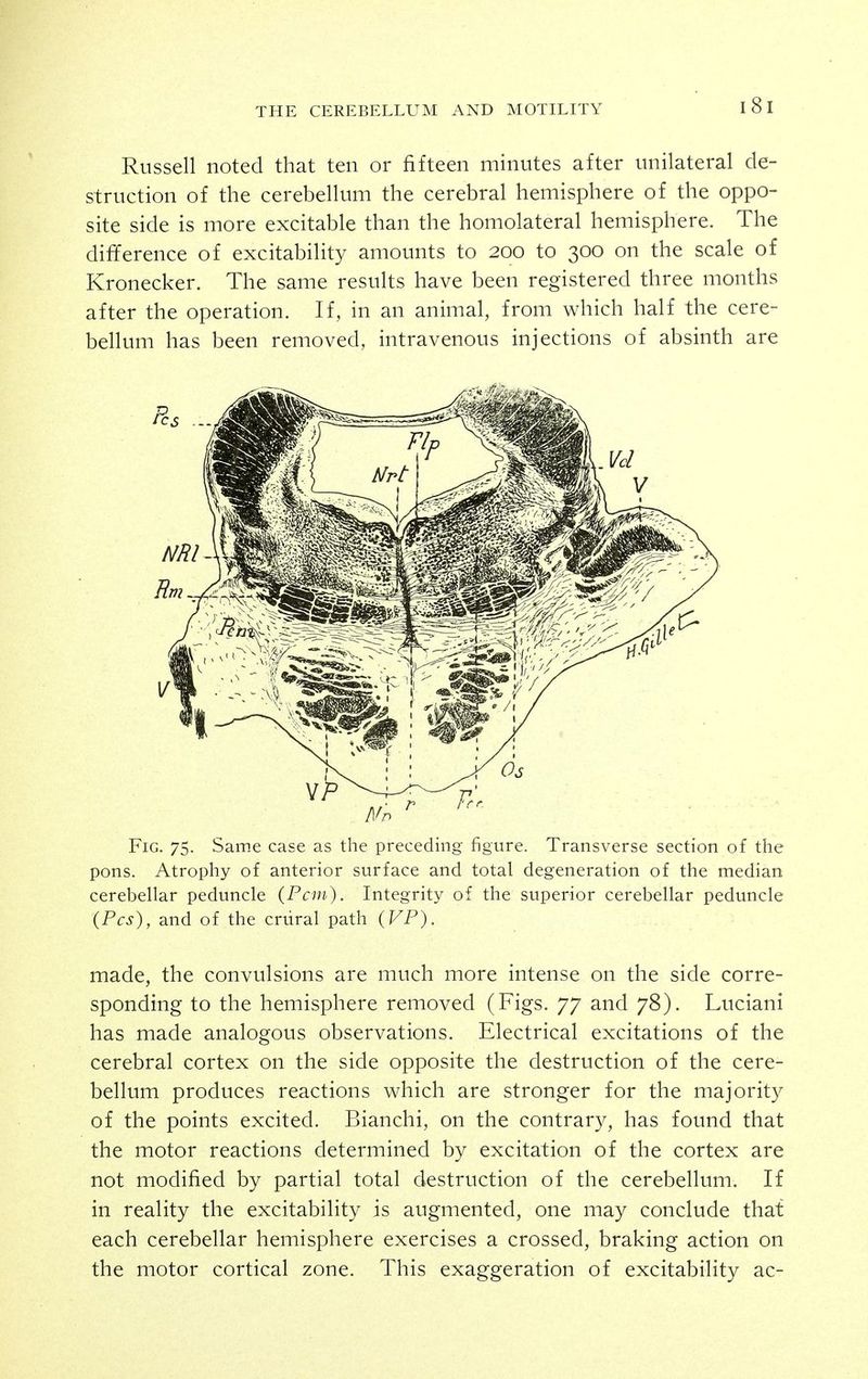 Russell noted that ten or fifteen minutes after unilateral de- struction of the cerebellum the cerebral hemisphere of the oppo- site side is more excitable than the homolateral hemisphere. The difference of excitability amounts to 200 to 300 on the scale of Kronecker. The same results have been registered three months after the operation. If, in an animal, from which half the cere- bellum has been removed, intravenous injections of absinth are Fig. 75. Same case as the preceding figure. Transverse section of the pons. Atrophy of anterior surface and total degeneration of the median cerebellar peduncle (Pcm). Integrity of the superior cerebellar peduncle (Pes), and of the crural path (VP). made, the convulsions are much more intense on the side corre- sponding to the hemisphere removed (Figs. 77 and 78). Luciani has made analogous observations. Electrical excitations of the cerebral cortex on the side opposite the destruction of the cere- bellum produces reactions which are stronger for the majority of the points excited. Bianchi, on the contrary, has found that the motor reactions determined by excitation of the cortex are not modified by partial total destruction of the cerebellum. If in reality the excitability is augmented, one may conclude that each cerebellar hemisphere exercises a crossed, braking action on the motor cortical zone. This exaggeration of excitability ac-