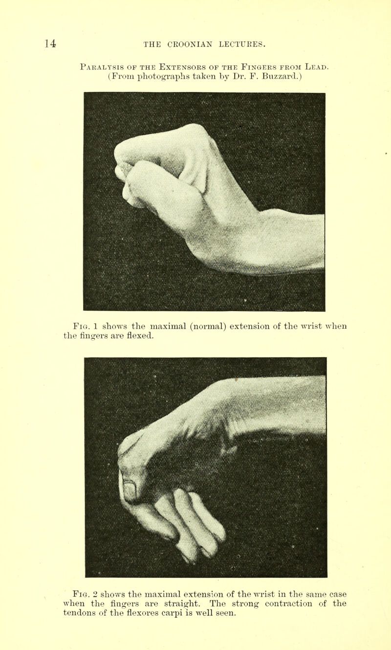 Paralysis of the Extensors of the Fingers from Lead. (From photographs taken by Dr. F. Buzzard.) Fig. 1 shows the maximal (normal) extension of the wrist when the fingers are flexed. Fig. 2 shows the maximal extension of the wrist in the same case when the fingers are straight. The strong contraction of the tendons of the flexores carpi is well seen.