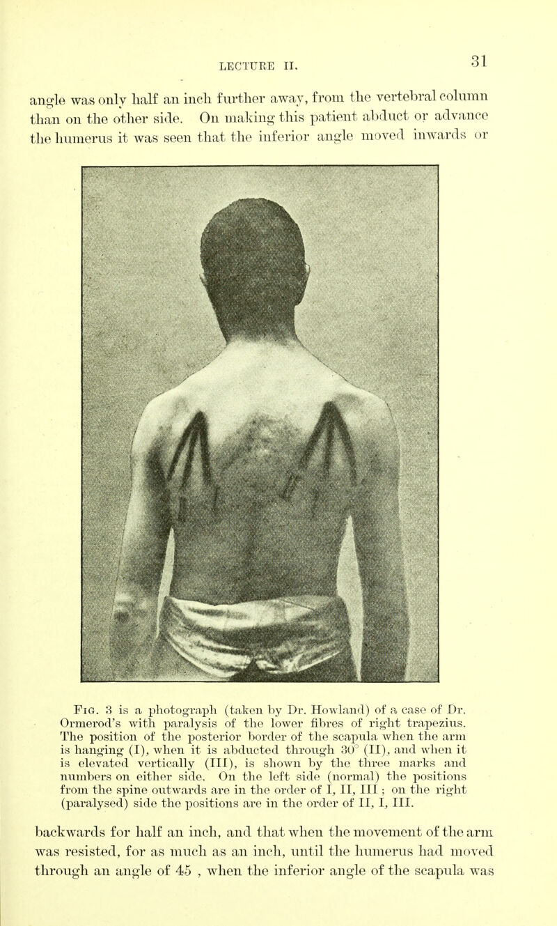 angle was only half an inch further away, from the vertebral column than on the other side. On making this patient abduct or advance the humerus it was seen that the inferior angle moved inwards or Fig. 3 is a photograph (taken by Dr. Howland) of a case of Dr. Ormerod's with paralysis of the lower fibres of right trapezius. The position of the posterior border of the scapula when the arm is hanging (I), when it is abducted through 30° (II), and when it is elevated vertically (III), is shown by the three marks and numbers on either side. On the left side (normal) the positions from the spine outwards are in the order of I, II, III; on the right (paralysed) side the positions are in the order of II, I, III. backwards for half an inch, and that when the movement of the arm was resisted, for as much as an inch, until the humerus had moved through an angle of 45 , when the inferior angle of the scapula was