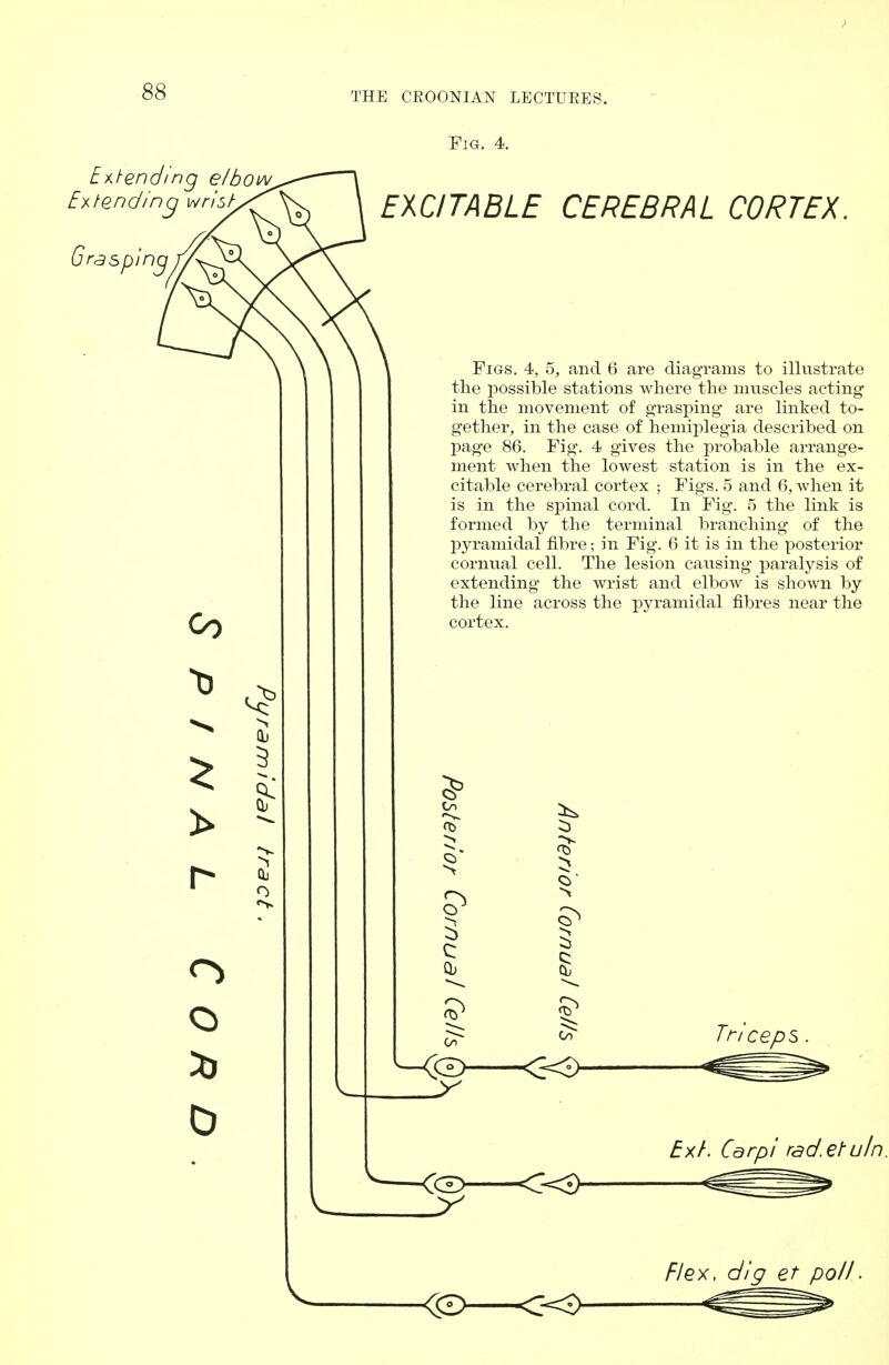 Fig. 4. Extending el bo Extending wrist G rasping EXCITABLE CEREBRAL CORTEX Co o Qj Figs. 4, 5, and 6 are diagrams to illustrate the possible stations where the muscles acting in the movement of grasping are linked to- gether, in the case of hemiplegia described on page 86. Fig. 4 gives the probable arrange- ment when the lowest station is in the ex- citable cerebral cortex ; Figs. 5 and 6, when it is in the spinal cord. In Fig. 5 the link is formed by the terminal branching of the pyramidal fibre; in Fig. 6 it is in the posterior cornual cell. The lesion causing paralysis of extending the wrist and elbow is shown by the line across the pyramidal fibres near the cortex. 3 c: Oj Co <30 Triceps Exl. Carpi rad.efuln