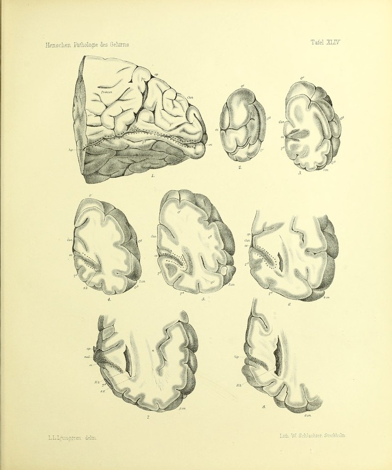 Bensclien. Pathologie des Geliinis LL.LjLingcfreii delin. Lith. W. Schlächter, Stockholm.