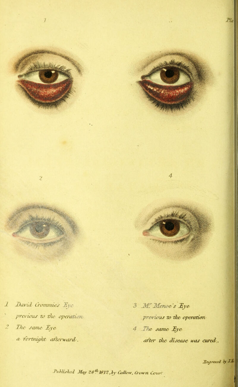 David Croimnies Bye previous to tl& operation The same Eye a fbrtnigJvt afterward. 3 Menoe/s Zye previous to the operation 4 .Tlw same* JEy& after -die disease Has cured,. PubUsheJ Mqy 26^1812,by GiUcw, Crown Court