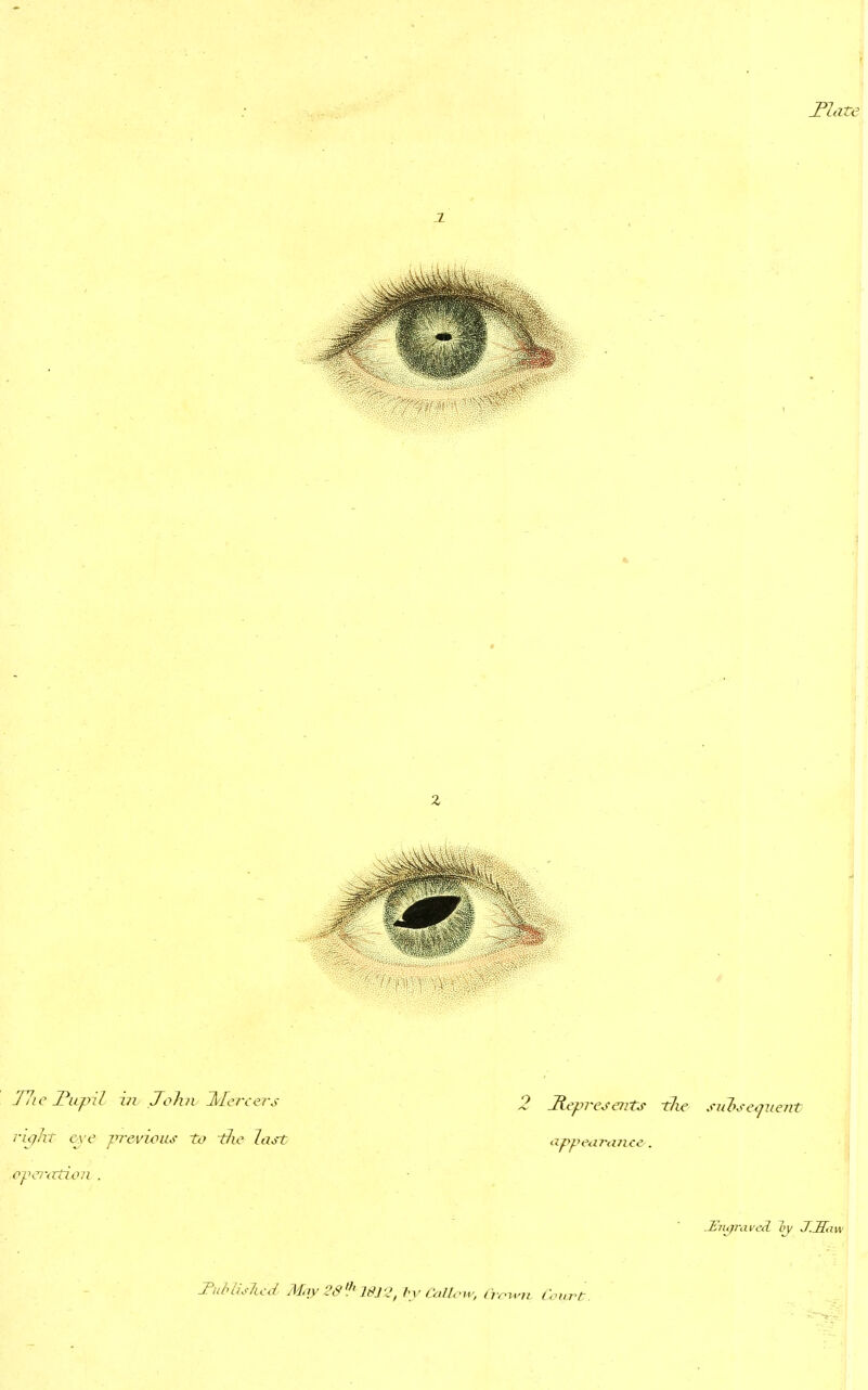 TJate T7ie 2\ipil in John Piercers right eye previous to Jie last hveration . 2 Represents tlie subsequent appearance . JSngraveeL iy J.Sa Tublislud MqyQd^WJ'^, by Callow, Crown. Court