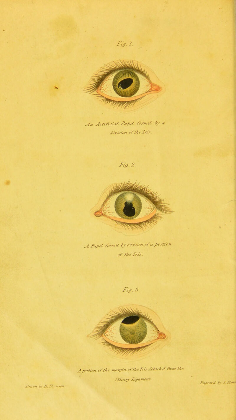 'yy. I. .4/1 Artificial Fu/tii ih/md ^ ciiviJ'it:' cfiAe Iris. ^ lUfiil A'nritf In-exdsioi cfci /'i'r/?i>n of fAf Iris. Apcreu'n , /'{/,>■ imini' rii/n-//is ,Un>r/i,/ /h-m ///<■ Dmnrt Jf.Thi*m.rcn.