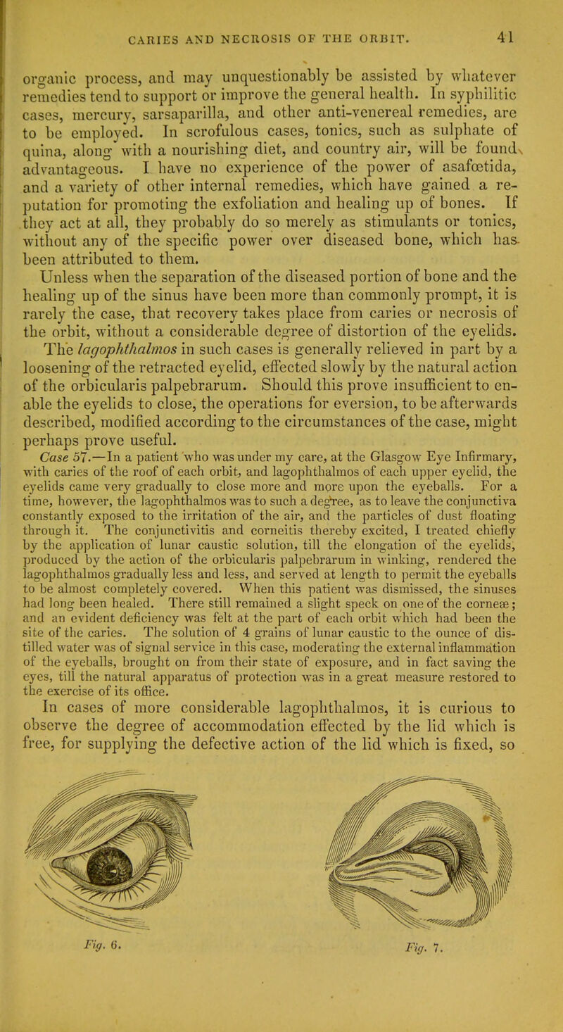 organic process, and may unquestionably be assisted by whatever remedies tend to support or improve the general health. In syphilitic cases, mercury, sarsaparilla, and other anti-venereal remedies, are to be employed. In scrofulous cases, tonics, such as sulphate of quina, along with a nourishing diet, and country air, will be foundN advantageous. I have no experience of the power of asafcetida, and a variety of other internal remedies, which have gained a re- putation for promoting the exfoliation and healing up of bones. If .they act at all, they probably do so merely as stimulants or tonics, without any of the specific power over diseased bone, which has- been attributed to them. Unless when the separation of the diseased portion of bone and the healing up of the sinus have been more than commonly prompt, it is rarely the case, that recovery takes place from caries or necrosis of the orbit, without a considerable degree of distortion of the eyelids. The lagophthalmos in such cases is generally relieved in part by a loosening of the retracted eyelid, effected slowly by the natural action of the orbicularis palpebrarum. Should this prove insufficient to en- able the eyelids to close, the operations for eversion, to be afterwards described, modified according to the circumstances of the case, might perhaps prove useful. Case 57.—In a patient who was under my care, at the Glasgow Eye Infirmary, with caries of the roof of each orbit, and lagophthalmos of each upper eyelid, the eyelids came very gradually to close more and more upon the eyeballs. For a time, however, the lagophthalmos was to such a de,^ee, as to leave the conjunctiva constantly exposed to the irritation of the air, and the particles of dust floating through it. The conjunctivitis and corneitis thereby excited, I treated chiefly by the application of lunar caustic solution, till the elongation of the eyelids, produced by the action of the orbicularis palpebrarum in winking, rendered the lagophthalmos gradually less and less, and served at length to permit the eyeballs to be almost completely covered. When this patient was dismissed, the sinuses had long been healed. There still remained a shght speck on one of the cornese; and an evident deficiency was felt at the part of each orbit which had been the site of the caries. The solution of 4 grains of lunar caustic to the ounce of dis- tilled water was of signal service in this case, moderating the external inflammation of the eyeballs, brought on from their state of exposure, and in fact saving the eyes, till the natural apparatus of protection was in a great measure restored to the exercise of its office. In cases of more considerable lagophthalmos, it is curious to observe the degree of accommodation effected by the lid which is free, for supplying the defective action of the lid which is fixed, so Fig. 6. Fig. 7.
