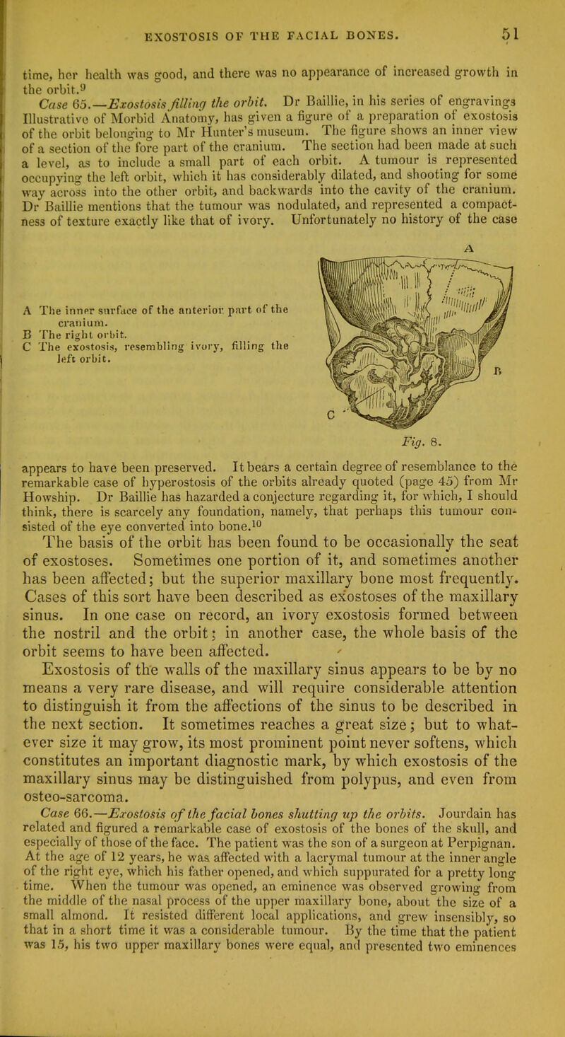 time, her health was good, and there was no appearance of increased growth in the orbit/J Case Qo.—Exostosis filling the orbit. Dr Baillie, in his series of engravings Illustrative of Morbid Anatomy* has given a figure of a preparation of exostosis of the orbit belonging to ^Ir Hunter's museum. The figure shows an inner view of a section of the fore part of the cranium. The section had been made at such a level, as to include a small part of each orbit. A tumour is _ represented occupying the left orbit, which it has considerably dilated, and shooting for some way across into the other orbit, and backwards into the cavity of the cranium. Dr Baillie mentions that the tumour was nodulated, and represented a compact- ness of texture exactly like that of ivory. Unfortunately no history of the case A A The inner surface of the anterior part of the cranium. B The right orbit. C The exostosis, resembling ivory, filling the left orbit. Fig. 8. appears to have been preserved. It bears a certain degree of resemblance to the remarkable case of hyperostosis of the orbits already quoted (page 45) from Mr Howship. Dr Baillie has hazarded a conjecture regarding it, for which, I should think, there is scarcely any foundation, namely, that perhaps this tumour con- sisted of the eye converted into bone.^'^ The basis of the oi'bit has been found to be occasionally the seat of exostoses. Sometimes one portion of it, and sometimes another has been affected; but the superior maxillary bone most frequently. Cases of this sort have been described as exostoses of the maxillary sinus. In one case on record, an ivory exostosis formed between the nostril and the orbit; in another case, the whole basis of the orbit seems to have been affected. Exostosis of the walls of the maxillary sinus appears to be by no means a very rare disease, and will require considerable attention to distinguish it from the affections of the sinus to be described in the next section. It sometimes reaches a great size; but to what- ever size it may grow, its most prominent point never softens, which constitutes an important diagnostic mark, by which exostosis of the maxillary sinus may be distinguished from polypus, and even from osteo-sarcoma. Case 66.—Exostosis of the facial hones shutting up the orbits. Jourdain has related and figured a remarkable case of exostosis of the bones of the skull, and especially of those of the face. The patient was the son of a surgeon at Perpignan. At the age of 12 years, he was affected with a lacrymal tumour at the inner angle of the right eye, which his father opened, and which suppurated for a pretty long time. When the tumour was opened, an eminence was observed growing from the middle of tlie nasal process of the upper maxillary bone, about the size of a small almond. It resisted different local applications, and grew insensibly, so that in a short time it was a considerable tumour. By the time that the patient was 15, his two upper maxillary bones were equal, and presented two eminences