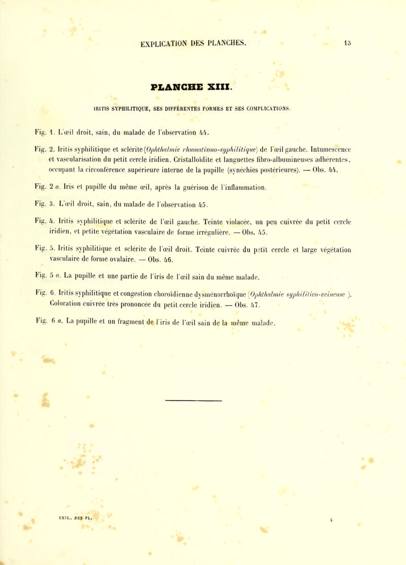 PLANCHE XIII. IRITIS SYPHILITIQUE, SES DIFFÉRENTES FORMES ET SES COMPLICATIONS. Fig. 1. L'œi! droit, sain, du malade de l'observation UU. Fig. 2. Iritis syphilitique et sdérhe {Ophthalmie rhumatismo-syphilitique) de l'œil gauche. Intumescence et vascularisation du petit cercle iridien. Cristalloïdite et languettes fibro-albumineuses adhérentes, occupant la circonférence supérieure interne de la pupille (synéchies postérieures). — Ohs. hk. Fig. 2 a. Iris et pupille du même œil, après la guérison de l'inflammation. ■ Fig. 3. L'œil droit, sain, du malade de l'observation 45. ■• ' ■ Fig. k. Iritis syphilitique et sclérite de l'œil gauche. Teinte violacée, un peu cuivrée du petit cercle iridien, et petite végétation vasculaire de forme irrégulière. — Obs. 45. Fig. 5. Iritis syphilitique et sclérite de l'œil droit. Teinte cuivrée du pstit cercle et large végétation vasculaire de forme ovalaire. — Obs. 46. Fig. 5 a. La pupille et une partie de l'iris de l'œil sain du même malade. • Fig. 6, Iritis syphilitique et congestion choroïdienne dysménorrhoïque (O^jMa/mï'e sypldlitico-veineuse ). Coloration cuivrée très prononcée du petit cercle iridien. — Obs. 47. • Fig. 6 a. La pupille et un fragment de l iris de l'œil sain de la même malade. ^%mL KXfr.. TES Pl.. 4