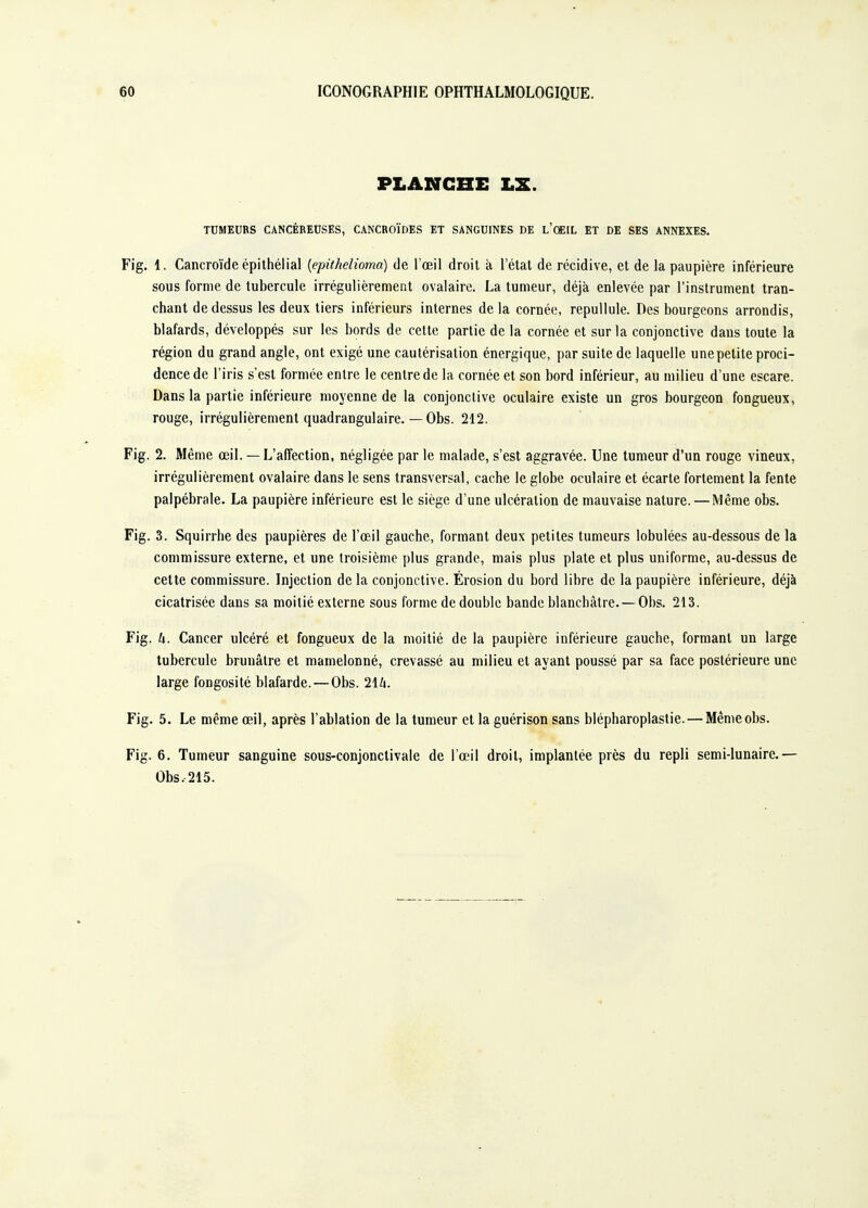 PLANCHE LX. TUMEURS CANCÉREUSES, CANCROÏDES ET SANGUINES DE l'œiL ET DE SES ANNEXES. Fig. 1. Cancroïde ëpithélial {epithelioma) de l'œil droit à l'étal de récidive, et de la paupière inférieure SOUS forme de tubercule irrégulièrement ovalaire. La tumeur, déjà enlevée par l'instrument tran- chant de dessus les deux tiers inférieurs internes delà cornée, repullule. Des bourgeons arrondis, blafards, développés sur les bords de cette partie de la cornée et sur la conjonctive dans toute la région du grand angle, ont exigé une cautérisation énergique, par suite de laquelle une petite proci- dencede l'iris s'est formée entre le centre de la cornée et son bord inférieur, au milieu d'une escare. Dans la partie inférieure moyenne de la conjonctive oculaire existe un gros bourgeon fongueux, rouge, irrégulièrement quadrangulaire. — Obs. 212. Fig. 2. Même œil. — L'affection, négligée par le malade, s'est aggravée. Une tumeur d'un rouge vineux, irrégulièrement ovalaire dans le sens transversal, cache le globe oculaire et écarte fortement la fente palpébrale. La paupière inférieure est le siège d'une ulcération de mauvaise nature. — Même obs. Fig. 3. Squirrhe des paupières de l'œil gauche, formant deux petites tumeurs lobulées au-dessous de la commissure externe, et une troisième plus grande, mais plus plate et plus uniforme, au-dessus de cette commissure. Injection de la conjonctive. Érosion du bord libre de la paupière inférieure, déjà cicatrisée dans sa moitié externe sous forme de double bande blanchâtre. —Obs. 213. Fig. h. Cancer ulcéré et fongueux de la moitié de la paupière inférieure gauche, formant un large tubercule brunâtre et mamelonné, crevassé au milieu et ayant poussé par sa face postérieure une large fongosité blafarde. — Obs. 1\h. Fig. 5. Le même œil, après l'ablation de la tumeur et la guérison sans blépharoplastie. — Mên^eobs. Fig. 6. Tumeur sanguine sous-conjonctivale de l'œil droit, implantée près du repli semi-lunaire.— Obs. 215.