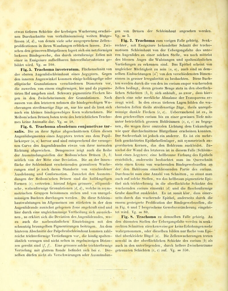 etwas tieferen Schichte der krebsigen Wucherung erschei- nen Durchschnitte von verhältnissmässig weiten Blutge- fässen {d, d), von denen viele sehr ausgesprochene Zellen- prolificationen in ihren Wandungen erblicken lassen. Zwi- schen den grösseren Blutgefässen lagert sich ein netzförmiges lockeres Bindegewebe, das durch sternförmige Zellen mit einer in Essigsäure aufhellbaren Intercellularsubstanz ge- bildet wird. Vg. = 100. Fig. 5. Trachoraa iiiveteratura. Fiächenschnitt von der oberen Augenlidschleimhaut eines Aegypters. Gegen den inneren Augenwinkel kommen einige halbkugelige oder elliptische Granulationen verschiedenen Diameters vor, die zuweilen von einem ringförmigen, hie und da pigmen- tirten Hof umgeben sind. Schwarz pigmentirte Flecken Ue- sen in den Zwischenräumen der Granulationen. Nach aussen von den letzteren nehmen die bindegewebigen Wu- cherungen streifenartige Züge an, nur hie und da lässt sich noch ein kleines bindegewebiges Korn wahrnehmen. Die Meibom'schen Drusen boten trotz des beträchtlichen Tracho- mes keine Anomalie dar. Vg. = 40. Flg. 6. Traohonia obsoletum conjunctivae tar- salis. Die an ihrer Spitze abgeschnittenen Cilien dieses Augenlidsegmentes eines Aegypters treten aus dem Papil- larkörper («, a) hervor und sind entsprechend der verzoge- nen Gurve des Augenlidrandes etwas von ihrer normalen Richtung abgewichen. Demgemäss zeigt auch die Reihe der Ausmlindungsstelien der Meibom'schen Drüsen (6, b) seillich von der Mitte eine Deviation. Die an der Innen- fläche der Schleimhaut erscheinenden granulösen Wuche- rungen sind je nach ihrem Standorte von verschiedener Ausdehnung und Conformation. Zunächst den Ausn)ün- dungen der Meibom'schen Drüsen sind die halbkugeligen Formen (c) vertreten; hierauf folgen grössere, ellipsoidi- sche, walzenförmige Granulationen {d, d), welche in asym- metrischen Gruppen beisammen stehen und von unregel- mässigen Buchten durchzogen werden. Da diese Schleim- hautwulstungen im Allgemeinen am stärksten in der dem Augenlidrande zunächst gelegenen Zone angehäuft sind und hier durch eine ungleichmässige Vertheilung sich auszeich- nen , so erklärt sich die Deviation des Augenlidrandes, wo- zu auch die narbenähnlichen Einziehungen mit den schmutzig braungelben Pigmentirungen beitragen. An dem hinteren Abschnitte der Palpebralschleimhaut kommen zahl- reiche trichterförmige Vertiefungen vor, die häufig spalten- ähnlich verzogen und nicht selten in regelmässigen Distan- zen gereiht sind (/, f). Eine grössere solche trichterförmige Vertiefung mit glattem Rande befindet sich bei e. Die- selben dürfen nicht als Verschwärungen oder Ausmündun- gen von Drüsen der Schleimhaut angesehen werden. Vg. = 5. Fig. 1. Trachonia zum vorigen Falle gehörig. Senk- rechter , mit Essigsäure behandelter Schnitt der Iracho- matösen Schleimhaut von der Uebergangsfalte des unte- ren Augenlides an einer solchen Stelle, wo noch mittelst des blossen Auges die Wulstungen und spaltenähnJichen Verliefungen zu erkennen sind. Das Epithel scheint von ungleicher Mächtigkeit zu sein (a, a), auch sind an dem- selben Einbuchtungen (o'j von den verschiedensten Dimen- sionen in grosser Irregularität zu beobachten. Diese Buch- ten werden durch die von den im corium empor wuchernden Zellen bedingt, deren grösste Menge stets in den oberfläch- lichen Schichten [h, b) sich anhäuft, so zwar, dass hier- durch eine sehr merkliche Abnahme der Transparenz er- zeugt wird. In den etwas tieferen Lagen bilden die wu- chernden Zellen theils streifenartige Züge, theils unregel- mässige dunkle Flecken (e, e). Ueberraschend ist es, in dem geschwellten corium bis zu einer gewissen Tiefe mit- unter beträchtlich grossen Hohlräumen (c, c, c) zu begeg- nen , die wegen ihrer centralen Lichtung dem Unkundigen wie quer durchschnittene Blutgefässe erscheinen könnten. Der Sachverhalt ist jedoch ein anderer. Es ist ein mehr- fach geschichtetes Epithelzellenlager, mit symmetrisch an- geordneten Kernen, das den Hohlraum auskleidet. Zu- nächst der Wand des letzteren ist in diesem Falle (Schleim- haut eines Aegyters) eine hellbraune Färbung des Epithels ersichtlich, anderseits beobachtet man im Querschnitt stets einen Kranz von wuchernden Bindegewebszellen an der den Hohlraum einschliessenden Partie des corium. Durchsucht man eine Anzahl von Schnitten, so stössl man auch auf solche Stellen, wo das hellbraun pigmentirte Epi- thel sich trichterförmig in die oberflächliche Schichte des wuchernden corium einsenkt [d) und die flaschenförmige Grube daselbst auskleidet. Es ist somit klar, dass einer- seits durch das wuchernde Epithel, anderseits durch die enorm gesteigerte Prolification der Bindegewebszellen , die in Fig. 6 und 7 besprochene Gewebsveränderung eingelei- tet wird. Vg. = 80. Fig. 8. Trachoiua zu demselben Falle gehörig. An den dünnsten Stellen der Uebergangsfalte werden in senk- rechten Schnitten streckenweise gar keineErhöhungen mehr wahrgenommen, oder dieselben bilden nur flache vom Epi- thel uberkleidete Hügel (a). Die Zellenwucherungen treten sowohl in der oberflächlichen Schichte des corium (6) als auch in den unterliegenden, durch hellere Zwischenräume getrennten Schichten (c, c) auf. Vg. = 350.