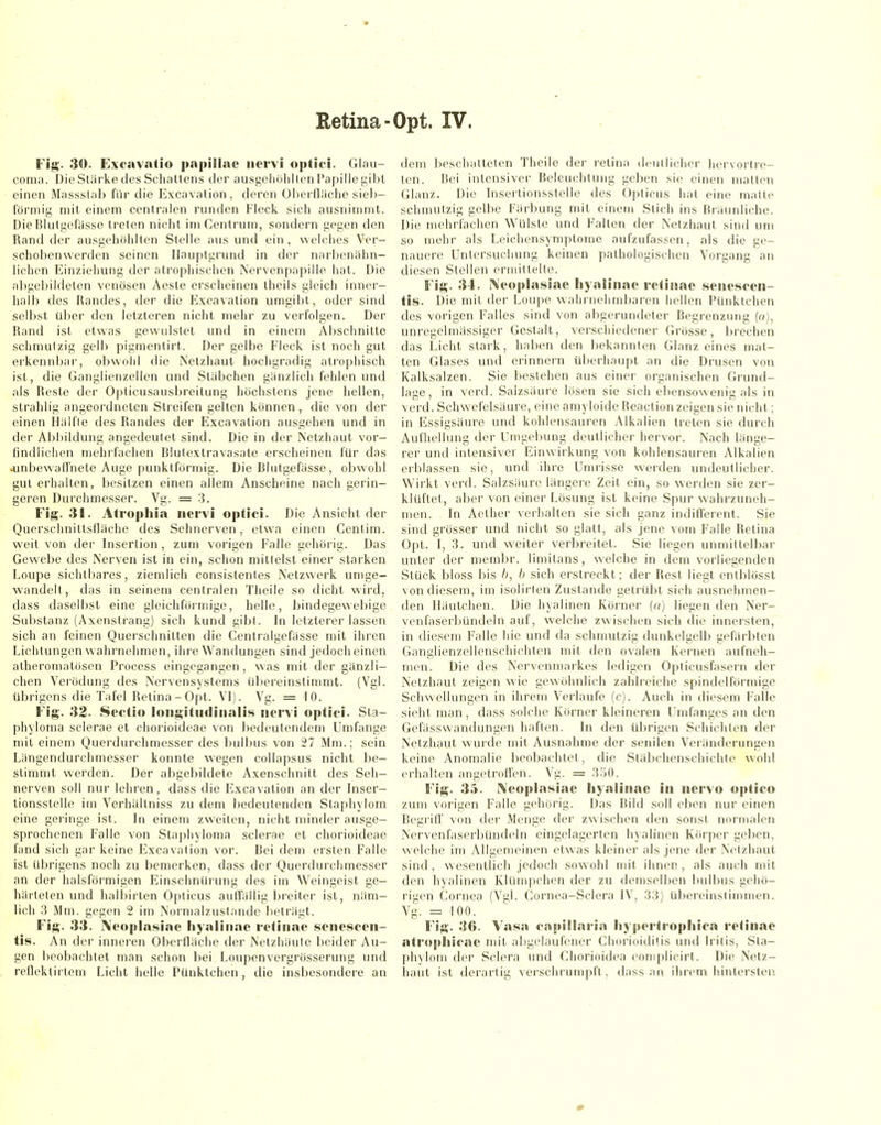 Retina-Opt. IV. Pig. 30. Excavatio pniiillac nervi optici. Glau- coma. Die Sliirke des Schaltens der ausgeliühllen l*apillec;il)l einen Massslab für die Excavalion, deren Üi)erll;iclie siei)- förmig mit einem centralen runden Fleck sich ausnimn)t. Die Blutgefässe treten nicht im Cenlrum, sondern gegen den Rand der ausgehöhlten Stelle aus und ein , welches Ver- schobenwerden seinen Hauptgrund in der narhcnähn- lichen Einziehung der atrophischen Nervenpapille hat. Die abgebildeten venösen Aesle erscheinen Iheils gleich inner- halb des Randes, der die Excavation umgibt, oder sind selbst über den letzteren nicht mehr zu verfolgen. Der Rand ist etwas gevvulstet und in einem Abschnitte schmutzig gelb pigmentirt. Der gelbe Fleck ist noch gut erkennbar, obwohl die Netzhaut hochgradig atrophisch ist, die Ganglienzellen und Stäbchen gänzlich fehlen und als Reste der Opticusausbreitung höchstens jene hellen, strahlig angeordneten Streifen gelten können, die von der einen Hälfte des Randes der Excavation ausgehen und in der Abbildung angedeutet sind. Die in der Netzhaut vor- findlichen mehrfachen Blutexlravasale erscheinen für das .unbewaffnete Auge punktförmig. Die Blutgefässe, oljwohl gut erhallen, besitzen einen allem Anscheine nach gerin- geren Durchmesser. Vg. = .3. Fig. 31. Ati'ophia nervi optici. Die Ansicht der Querschniltsnäche des Sehnerven, etwa einen Cenlim. weit von der Insertion , zum vorigen Falle gehörig. Das Gewebe des Nerven ist in ein, schon mitlelst einer starken Loupe sichtbares, ziemlich consistenles Netzwerk unige- vs'andell, das in seinem centralen Theile so dicht wird, dass daselbst eine gleichföiniige, helle, bindegevvef)ige Substanz (Axenstrang) sich kund gibl. In letzterer lassen sich an feinen Querschnilten die Centralgefässe mit ihren Lichtungen w ahrnehmen, ihre Wandungen sind jedoch einen atheromatüsen Process eingegangen, was mit der gänzli- chen Verödung des Nervensystems ül)ereinstimmt. (Vgl. übrigens die Tafel Retina-Opt. VI). Vg. = 10. Fig'. 32. Sectio longitndinali«« nervi optici. Sla- phylonia scierae et chorioideae von bedeutendem Umfange mit einem Querdurchmesser des bulbus von 27 Mm.; sein Längendurchmesser konnte wegen collapsus nicht be- stimmt werden. Der abgebildete Axenschnitt des Seh- nerven soll nur lehren, dass die Excavation an der hiser- tionsstelle im Verhältniss zu dem bedeutenden Staphylom eine geringe ist. In einem zweiten, nicht minder ausge- sprochenen Falle von Staphyloma scierae et chorioideae fand sich gar keine Excavation vor. Bei dem ersten Falle ist übrigens noch zu bemerken, dass der Querdurclimesser an der halsförmigen Einschnürung des im Weingeist ge- härteten und halljirten Opticus auffällig breiter isl, näm- lich 3 Mm. gegen 2 im Normalzustande beträgt. Fig. 33. ]\eopla8iae liyalinac retinae senescen- tis. An der inneren Oberfläche der Netzhäute beider Au- gen beobachtet man schon bei I^oupenvergrösserung und reflektirtem Licht helle Pünktchen , die insbesondere an dem beschatteten Theile der retina deutlicher hervortre- ten. Bei intensiver Beleuchtung geben sie einen mallen Glanz. Die bisei'lionsslelle des Ö])licus hat eine malle schmutzig gelbe Färbung mit einem Stich ins Bräunliche. Die mehrfachen Wülste und Fallen der Netzhaut sind um so mehr als Leichensymptome aufzufassen, als die ge- nauere Untersuchung keinen palhologischen Vorgang an diesen Stellen ermiUelte. Fig. 34. Neoplasiae liyalinae retinae senescen- tis. Die mit der Loupe wahrnehmbaren hellen Pünktchen des vorigen Falles sind von abgerundeter Begrenzung (o), unregelmässiger Gestalt, verschiedener Grosse, brechen das Licht stark, haben den jjekannten Glanz eines mat- ten Glases und erinnern überhaupt an die Drusen von Kalksalzen. Sie bestehen aus einer organischen Grund- lage, in verd. Salzsäure lösen sie sich ebensowenig als in verd. Schwefelsäure, eine amyloide Reaclion zeigen sie nicht; in Essigsäure und kohlensauren Alkalien treten sie durch Aufhellung der Umgebung deutlicher hervor. Nach länge- rer und intensiver Einwirkung von kohlensauren Alkalien erblassen sie, und ihre Unu'isse werden undeutlicher. Wirkt verd. Salzsäure längere Zeit ein, so werden sie zer- klüftet, aber von einer Lösung ist keine Spur wahrzuneh- men. In Aether verhalten sie sich ganz indifferent. Sie sind grösser und nicht so glatt, als jene vom Falle Retina Opt. I, 3. und weiter verbreitet. Sie liegen unmittelbar unter der membr. limitans, welche in dem vorliegenden Stück bloss bis b, h sich erstreckt; der Rest liegt enlblösst von diesem, im isolirteu Zustande gelrUbt sich ausnelimen- den Hänichen. Die hyalinen Körner (a) liegen den Ner- venfaserbündeln auf, welche zwischen sich die innersten, in diesem Falle hie und da schmutzig dunkelgelb gefärbten Ganglienzellenschichten mit den ovalen Kernen aufneh- men. Die des Nervenmarkes ledigen Oplicusfasern der Netzhaut zeigen wie gewöhnlich zahlreiche spindelförmige Schwellungen in ihrem Verlaufe (c). Auch in diesem Falle sieht man, dass solche Körner kleineren Umfanges an den Gefässwandungen haften. In den übrigen Schichten der Netzhaut wurde mit Ausnahme der senilen Veränderungen keine Anomalie beobachtet, die Släbchenschichle wohl erhallen angetroffen. Vg. = 3o0. Fig. 35. I\eoplasiae liyalinac in nervo optico zum vorigen Falle gehurig. Das Bild soll eben nur einen Begriff \on der Menge der zwischen den sonst normalen Nervenfaserbündeln eingelagerten hyalinen Körper geben, welche im Allgemeinen etwas kleiner als jene der Netzhaut sind , w esenllich jedoch sowohl mit ihnen , als auch mit den hyalinen Klümpchen der zu demselben bulbus gehö- rigen Cornea (Vgl. Cornea-Sclera IV, 33) übereinstimmen. Vg. = 100. Fig. 36. Yasa capillaria hypertrophica retinae atro|ihicae mit aligelaufcner Chorioiditis und liitis, Sta- phylom der Sclera und Chorioidea complicirt. Die Netz- haut ist derartig verschrumpft, dass an ihrem hintersten