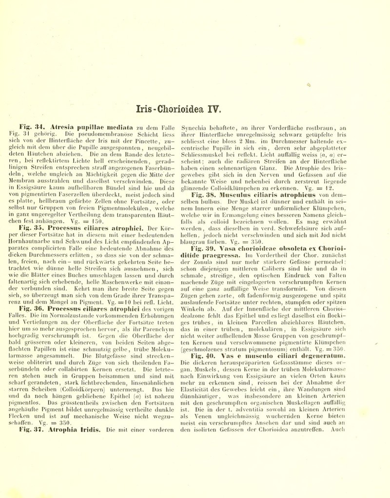 Iris-Chorioidea IV. Fig. 34. Atrcsin pupillae nuMliiita zu dem Falle Fig. 31 gehöi'iü;. Die pscudomeml)rauüse Schicht liess sich von der llinterflache der Iris mit der Pincelte, zu- gleich mit dem über die Pupille ausgespannten, neugebil- deten Ilautchen abziehen. Die an dem Rande des letzte- ren , bei reflektirlem Lichte hell erscheinenden, gerad- linigen Streifen entsprechen straff angezogenen Faserbiin- deln, welche ungleich an Mächtigkeit gegen die Mitte der Membran ausstrahlen und daselbst vei-schwinden. Diese in Essigsäure kaum aufhellbai'en Bündel sind hie und da von pigmenlirten Faserzellen üljerdeckt, meist jedoch sind es platte, hellbraun gefärbte Zellen ohne Fortsätze, oder selbst nur Gruppen von freien Pigmentmolekülen, welche in ganz ungeregelter Vertheiking dem transparenten Uäut- chen fest anhangen. Vg. = 150. Fig. 35. Processus ciliares atrophici. Der Kör- per dieser Fortsätze hat in diesem mit einer ])edeutenden Hornhaulnarbe und Schwund des Licht empfindenden Ap- parates complicirlen Falle eine bedeutende Abnahme des dicken Durchmessers erlitten , so dass sie von der schma- len, freien, nach ein - und rückwärts gekehrten Seile be- trachtet wie dünne helle Streifen sich ausnehmen, sich wie die Blätter eines Buches umschlagen lassen und durch faltenarlig sich erhebende, helle Maschenvverke mit einan- der verbunden sind. Kehrt man ihre breite Seite gegen sich, so überzeugt man sich von dem Grade ihrer Transpa- renz und dem Mangel an Pigment. Vg. =10 bei refl. Licht. Fig. 36. Processus ciliares atrophici des vorigen Falles. Die im Normalzustande vorkommenden Erhöhungen und Vertiefungen an der Oberfläche der Foitsätze treten hier um so mehr ausgesprochen hervor, als ihr Parenchym hochgradig verschrumpft ist. Gegen die Oberfläche der bald grösseren oder kleineren, von beiden Seiten abge- flachten Papillen ist eine schmutzig gelbe, trübe Moleku- larmasse angesammelt. Die Blutgefässe sind strecken- weise obliterirt und durch Züge von sich theilenden Fa- serbündcln oder collabirlen Kernen ersetzt. Die letzte- ren stehen auch in Gruppen beisammen und sind mit scharf gerandeten, stark lichlbrechenden, linsenähnlichen starren Scheiben (Colloidkörpern) untermengt. Das hie und da noch hängen gebliebene F]pithel (a) ist nahezu pigmentlos. Das grösstentheils zwischen den Fortsätzen angehäufte Pigment bildet unregelmässig vertheilte dunkle Flecken und ist auf mechanische Weise nicht wegzu- schafl'en. Vg. = 350. Fig. 31. Atropliia Iritlis. Die mit einer vorderen Synechia behaftete, an ihrer Vorderflache rostbraun, an ihrer [linierfläche unregelmässig schwarz getüpfelte Iris schliesst eine bloss 2 Mm. im l3urchmesser haltende ex- centrische Pupille in sich ein, deren sehr abgeplatteter Schliessmuskel bei reflekt. Licht auffällig weiss (a, a) er- scheint; auch die radiären Streifen an der Hinterfläche haben einen sehnenartigen Glanz. Die Atrophie des Iris- gewebes gibt sich in den Nerven und Gefässen auf die bekannte Weise und nebenljei durch zerstreut liegende glänzende Colloidklümpchen zu erkennen. Vg. = 12. Fig. 38. Musculus ciliaris atrophicus von dem- selben ljulbus. Der Muskel ist dünner und enthält in sei- nem Innern eine Menge starrer unförmlicher Klümpchen, welche wir in Ermangelung eines besseren Namens gleich- falls als colloid bezeichnen wollen. Es mag erwähnt werden, dass dieselben in verd. Schwefelsäure sich auf- hellen, jedoch nicht verschwinden und sich mit Jod nicht blaugrau färben. Vg. = 350. Fig. 39. Vasa cJiorioi<!eae obsoleta ex Chorioi- ditide praegressa. Im Vorderlheil der Chor, zunächst der Zonula sind nur mehr släikere Gefässe permeabel: schon diejenigen mittleren CalIbers sind hie und da in schmale, streifige, den optischen Eindruck von Fallen machende Züge mit eingelagerten verschrumpften Kernen auf eine ganz auffällige Weise transformirt. Von diesen Zügen gehen zarte, oft fadenförmig ausgezogene und spitz auslaufende Fortsätze unter rechten, stumpfen oder spitzen Winkeln ab. Auf der Innenfläche der mittleren Chorioi- dealzone fehlt das Epithel und es liegt daselbst ein flocki- ges trübes, in kleinen Parcellen abziehbares Häutchen, das in einer trüben, molekularen, in Essigsäure sich nicht weiter aufhellenden Masse Gruppen von geschrumpf- ten Kernen und verschwommene pigmentiite Klümpchen (geschmolzenes Stratum pigmentosum) enthält. Vg. = 350. Fig. 40. Vas e uiusculo ciliari degeueratuiu. Die dickeren herauspräparirlen Gefässstämme dieses Or- gan. Muskels, dessen Kerne in der trüben Molekularmasse nach l^inwirkung von Essigsäure an vielen Orten kaum mehr zu erkennen sind, reissen bei der Abnahme der Elaslicität des Gewebes leicht ein, ihre Wandungen sind dünnhäutiger, was insbesondere an kleinen Arterien mit den geschrumpften oiganischen Muskellagen aufl'ällig ist. Die in der t. adventilia sowohl an kleinen Arterien als Venen ungleichmässig wuchernden Kerne bieten meist ein verschrumpftes Ansehen dar und sind auch an den isolirten Gefässen der Chorioidea anzutreflen. Auch