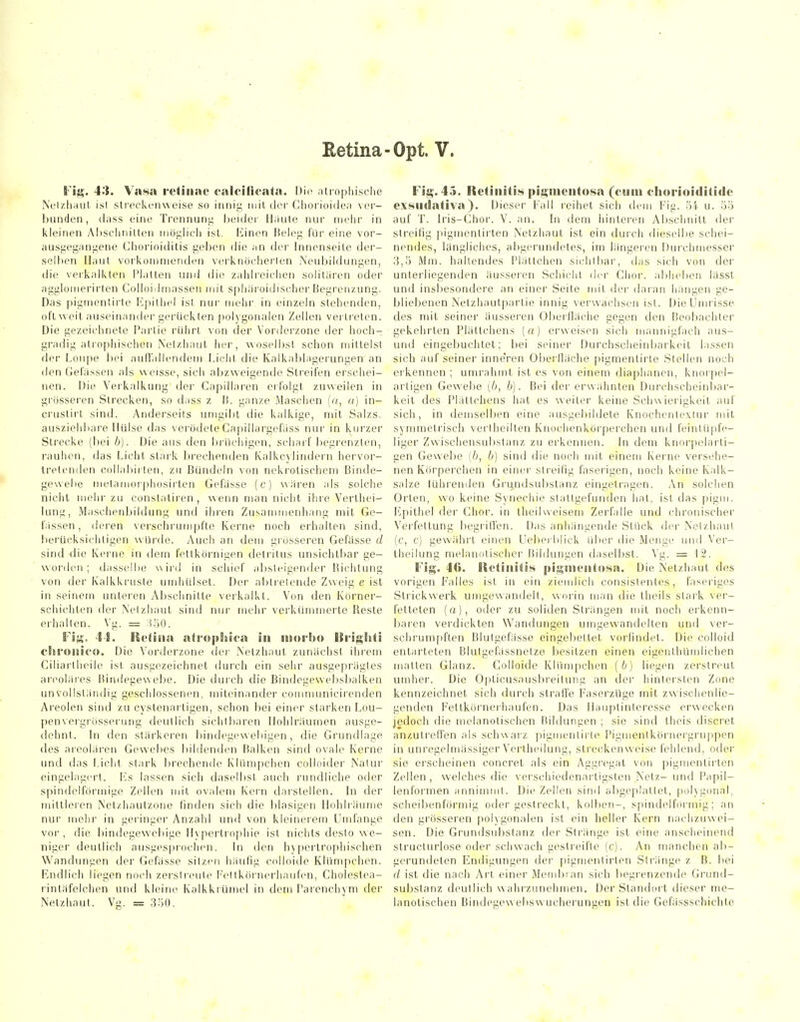 Eetina-Opt. V. Fifä,-. 43. Vas5» retinae eaicilic-ata. Die atro|)lii,sche Nc'lzliaul isl streckenweise so innig inil der Cliorioidea ver- bunden , dass eine Trennuni; Ijeider lliiule nur mehr in kleinen Ar)schnilten iiiögiicli isl. liinen Beleg für eine vor- ausgegangene Chorioiditis geben die an der Innenseite der- selben Haut vorkommenden verknöcherlen Neubildungen, die verkalkten i'l.ilten und die zahlreichen solitaren oder aggloiiierirlen Colloiilinassen mit spluiroidischei' Begrenzung. Das pigmentirle Kjiithel ist nui' mehr in einzeln stehenden, oft weit auseinander gerückten |)olygonalen Zellen vertreten. Die gezeichnete Partie rührt von der Vorderzone der hoch- gradig atrophischen Netzhaut her, woselbst schon millelsl der Loiipe bei auflallendem Licht die Kalkablagerungen an den Gelassen als weisse, sich abzweigende Streifen erschei- nen. Die Verkalkung der Capillaren eii'olgt zuweilen in grösseren Strecken, so d.iss z B. ganze Maschen («, u) in- crustirl sind. Anderseils umgibt die kalkige, mit Salzs. ausziehbare Hülse das vei'ödeleCapillargefass nur in kurzer Strecke (])ei b). Die aus den brüchigen, scharf begrenzten, rauhen, das Licht stark brechenden Kalkcjlindern hei'vor- trelenden collal)irlen, zu Bündeln von nekrotischem Binde- gewebe metamoi'phüsirten Gefasse (c) wären als solche nicht mehr zu conslatiren, wenn man nicht ihre Verthei- lung, Maschenljiklung und ihien Zusammenhang mit Ge- bissen, deren verschrumpfle Kerne noch erhalten sind, berücksichtigen würde. Auch an dem grosseren Gefässe d sind die Kerne in dem fettkörnigen delritus unsichtbar ge- worden ; dasselbe wird in schief al)steigender Richtung von dei' Kalkki'usle umhülsel. Dei' al)trelende Zweig e isl in seinem unteren Abschnitte verkalkt. Von den Körner- schichten der Xelzhaul sind nur mehr verkümmerte Beste erhallen. Vg. = :^;iO. Fis. 14. fle^iiia atrophica in ntoiim Urij^Eiti cSiS'OiBi«-». Die Vorderzone der Netzhaut zunächst ihrem Ciliartheile ist ausgezeichnet durch ein sehr ausgeprägtes areoläres Bindegewebe. Die durch die Bindegewebsbalken unvollständig geschlossenen, miteinander communicirenden Areolen sind zu cystenai'tigen, schon bei einer starken Lou- penveigrösserung deutlich sichtbaren Hohlräumen ausge- dehnt. \n den stärkeren bindegewebigen, die Grundlage des areolären Gewebes bildenden Balken sind ovale Kerne und das Licht, stark brechende Klümpchen colloider Nalur eingelagert. Ivs lassen sich daselbst auch rundliche oder spindelförmige Zellen mit ovalem Kern darstellen, bi der mittleren Net/.hautzone finden sich die l)lasigen Hohlräume nur mein- in geringer Anzahl und von kleinerem Umfange vor, die bindegewebige Hypertrophie ist nichts desto we- niger deutlich ausgespiochen. In den hypertrophischen Wandungen der Gefässe sitzen häufig colloide Klümpchen. Endlich liegen noch zerstreute Feltkörnerhaufen, Choleslea- rintäfelchen und kleine Kalkkrümel in dem Parenchym der Netzhaut. Vg. = 3;iO. Fii?. 45. Retinitis pi;L;mciito8a (eiiiu cliorioiditidc exsiulativa). Dieser Fall reihet sich ilem Fia. 54 u. 55 auf T. b'is-Chor. V. an. In dem hinteren Abschnitt der streifig pigmentirlen Netzhaut isl ein durch dieselbe schei- nendes, längliches, abgerundetes, im längeren Dui'chmesser 3,0 Mm. hallendes Plättchen sichlliar, das sich von der unterliegenden äusseren Schicht der Chor. a!>hel)en lässl und insbesondere an einer Seite mit der daran himgen ge- bliebenen Netzhautpartie innig verwachsen isl. Die Umrisse des mit seiner äusseren Oljerfläche gegen den Beobachter gekehrten Plättchens (a) erweisen sich mannigfach aus- und eingebuchtet; bei seiner Durchscheinbarkeil lassen sich auf seiner inneVen Oberfläche pigmentirte Stellen noch erkennen ; umrahmt ist es von einem diaphanen, knorpel- arligen Gewebe (6, 6). Bei der erwähnten f)urchscheinbar- keil des Plättchens hal es weiter keine Schwierigkeit auf sich, in demselben eine ausgebildete Knochcnlexlur mit symmetrisch verlheilten Knochenkörperchen und feinlüpfe- liger Zwischensubstanz zu erkennen. In dem knorpelarti- gen Gewebe (6, b) sind die noch mit einem Kerne versehe- nen Körperchen in einer streifig faserigen, noch keine Kalk- salze tührenden Grundsubslanz eingetragen. An solchen Oi'ten, wo keine Synechie stattgefunden lial. isl das pigm. l^pilhel der Chor, in Iheilweisem Zerfalle und chronischer Verfettung liegriflen. Das anhängende Stuck der Netzhaut (c, c) gewähi't einen Uebei blick über die Menge und Ver- theilung melanntischer Bildungen daselbst. Vg. = 12. Fig. 46. Retinitis pi^ntentosn. Die Netzhaut des voi'igen Falles ist in ein ziemlich consislentes, fasei'iges Slrickwerk umgewandelt, woi'in man die Iheils stark ver- fetteten (a), oder zu soliden Strängen mit noch erkenn- baren verdickten Wandungen umgewandelten und ver- schrumpften Blutgefässe eingebettet vorfindet. Die colloid entarteten Blutgefässnetze besitzen einen eigenthümlichen matten Glanz. Colloide Klümpchen (b) liegen zerstreut umher. Die 0|)ticusausbreitung an der hintersten Zone kennzeichnet sich durch strafl'e Faserzüge mit zwischenlie- genden F'ellkörneihaufen. Das Hauptinteresse erwecken jedoch die mclanotischen Bildungen ; sie sind theis discrel anzutrefl'en als schwätz pigmentirle Pigmentkörnei'gruppen in unregelmässiger Verlheilung, streckenweise fehlend, oder sie erscheinen concrel als ein Aggregat von pigmentirlen Zellen , welches die verschiedenartigsten Netz- und Papil- lenformen annimml. Die Zellen sind abgeplatlet, [Kilygonal, scheil)enförmig oder gestreckt, kolben-, spindelhii'inig; an den giösseren poKgonalen ist ein heller Kern nachzuwei- sen. Die Grundsubstanz der Stränge ist eine anscheinend slructurlose oder schwach gestreifte (c). An manchen ab- gerundeten Endigungen der pigmenlirlen Stränge z B. bei d ist die nach Art einer Membran sich begrenzende Grund- substanz deullich wahrzunehmen. Der Standort dieser me- lanolischen Bindegewel)sw ucherungen isl die Gefässschichle