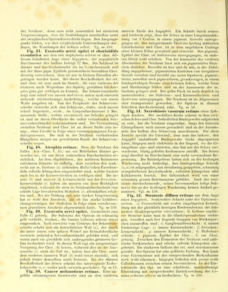 der Netzhaut, denn man sieht namentlich hei stärkeren Vergrösserungen, dass die Neubildungen unmittelbar unter der atrophischen Opticusfaserschicht liegen. Den Ausgangs- punkt Ijilden, wie dies vergleichemJe Untersuchungen dar- thuen, die Wandungen der Gefässe selbst. Vg. = 100. Fi;!;. 41. Excavatio nervi optici et Chorioiditis exsudativa aus dem mit slaphyloma scierae et chor. dif- fusum behafteten Auge eines Aegypters; der aequatoriale Durchmesser des bulbus betragt 27 Älm. Die Netzhaut ist dunner und durchscheinender als im Normalzustände und mit der ihres pigm. Epithels grösstentheils beraubten Ghor. derartig verwachsen, dass sie nur in kleinen Parcellen ab- getragen werden kann. Bei dieser BeschalTenheit der ret. und chor. ist man auch im Stande, die vasa vorticosa der letzteren nach Wegnahme des tiipfelig getrübten Glaskör- pers ganz gut verfolgen zu können. Die Sehnervenscheibe zeigt eine schief von aussen und etwas unten nach einwärts ziehende trichterförmige Aushöhlung, welche von einem Walle umgeben ist. Von der Peripherie der Sehnerven- scheibe erstreckt sich eine lichtgraue, trübe, nach aussen scharf begrenzte, ovale, im Längendurchmesser 5 Mm. messende Stelle, welche excentrisch zur Scheibe gelagert ist und an deren Oberfläche die radiär verlaufenden Seh- nervenfaserbUndel wahrzunehmen sind. Die Verwachsung zwischen Netzhaut und Chor, ist an dieser Stelle eine in- nige, ohne Zweifel in P'olge eines vorausgegangenen Exsu- dativprocesses. Die sich in der Netzhaut verlheilenden Blutgefässe steigen am gewulsteten Rande der Sehnerven- scheibe empor. Fig. 48. Atropliia retinae. Dass die Netzhaut des Falles (Iris-Chor. V. 84) um ein Mehrfaches dünner ge- worden sei, ist aus ihren senkrechten Durchschnitten er- sichtlich. An dem abgebildeten , der mittleren Retinazone entlehnten Schnitte ist auffällig, dass zwischen den senk- recht zur m. lin)itans {n) ziehenden Mülle raschen Faserbün- deln colloide Klüm[)chen eingeschaltet sind, welche letztere auch bis in (iie Körnerscliichten zu verfolgen sind. Die in- nere (6) und äussere (d) Körnerschicht mit der Zwisclien- körnerschicht (c) haben am meisten von ihrer Mächtigkeit eingebUsst, während die stets im Nelzhautdurchschnitt eine schiefe Lage bewahrenden Stäbchen (e) allenthalben erhal- ten sind. Bei der Prüfung mit sehr starker Vergrösserung hat es wohl den Anschein, als ob das starke Lichtbre- chungsvermögen der Stäbchen in Folge eines verschwom- men granulären Ansehens abgenommen hätte. Vg. = 350. Fig. 49. Excavatio nervi optici. Axenschnitt zum Falle 47 gehörig. Die Substanz des Opticus ist schmutzig gelb verfärbt, trocken, die lamina'cribrosa scierae etwas eingesunken. Nach einwärts vom Centrum der Sehnerven- scheibe erhebt sich ein beträchtlicher Wall (a), der durch die unter einem sehr spitzen Winkel zur Retinaloberfläche vorwärts ziehenden iNervenfaserbündel gebildet wird, und worin auch ein gleichfalls sich umbeugendes grösseres Ge- fäss beobachtet wird. In diesen Wall ragt ein zungenarliger Vorsprung der Chor, (b) herein, während dies an der Aus- senseite (c) nicht der Fall ist, indem hier idie Chor, unter dem niederen äusseren W^all (d) wohl etwas einsinkt, sich jedoch hinter demselben nicht fortsetzt. Bei der dünnen Beschaffenheit der Sclera scheint das intravaginale Trabe- kelgesvebe (e, e) w-eiter nach vorwärts geschoben. Vg. = 12. Fig. 50. Cancer melanoticus retinae. Eine un- gefähr citronengrosse Geschwulst sitzt an dem vorderen unteren Theile des Augapfels. Ein Schnitt durch erstere und letzteren zeigt, dass die Sclera in einer Längenausdeh- nung von 1 Cenlim. in einem pigment. Gewebe unterge- gangen sei. Der entsprechende Theil der krebsig infilli irten Ciliarforlsälze und Ghor. ist in dem ungefähren Umfange einer kleinen Erbse gewulslet und erweicht. Das pigment. Epithel der Chor, ist stellenweise unlergegangen, an ande- ren Öl ten wohl erhalten. Von der Innenseile des vorderen Abschnittes der Netzhaut lässl sich ein pigmenlirtes lläut- chen abziehen. Dasselbe ist hier und da mit, in der Abbil- dung angegebenen, pigmenlirlen Knötchen von irregulärer Gestalt versehen und Ijeslehl aus meist bipolaren, pigmen- lirlen, zuweilen auch pigmenllosen, grosskernigen, in einem bindegewebigen Stroma eingebetteten Zellen, welche Netze und Streilenzüge bilden und an der Aussenseite der m. limitans gelagert sind. Der gelbe Fleck ist noch deutlich zu unterscheiden; die Stäbchen- und Körnerschichten sind iheilweise untergegangen. Die Netzhaut ist im Allgemeinen eher transparenter geworden, der Opticus in dünnen Schichten durchscheinend, zähe. Vg. = 130. Fig. 51. Necrobiosis vasoruni retinae eines 2jäh- rigen Knaben. Der medulläre Krebs scheint in dem zwi- schen Sclera und Chor, befindlichen Bindegewebe aufgetreten zu sein, hat die Netzhaut eingestülpt, längs den hinleren Ciliargefässen nach aussen gewuchert und an der Aussen- seite des bulbus den Sehnerven umschlossen. Für diese Ansicht spricht der Umstand, dass man das lockere, den Augapfel umhüllende Bindegewebe leicht abpräpariren kann, hingegen nach rückwärts in der Gegend, wo die Ci- liargefässe aus- und eintreten, eine fest mit der Sclera ver- wachsene, blutig gefärbte Krebsmasse antrifft. Die Sclera zeigt daselbst im Durchschnitt eine mehr verwaschene Be- grenzung. Die Retinalgefässe haben sich an der krebsigen Wucherung nicht belheiligl, ihre bindegewebige Scheide (a, a) ist aufgequollen, mit sternförmig gruppirten, schmutzig orangefarbenen Krystallnadeln , colloiden Klümpchen oder Kalkkörnern besetzt. Der Gefässinhalt wird von einer schmutzig grauen Detritusmasse gebildet. Auch der resi- stente durchscheinende, seines Nervenmarkes ledige Seh- nerve hat an der krebsigen Wucherung keinen Antheil ge- nommen. Vgl. = 450. Fig. 52. Steatosis diffusa retinae aus dem Auge eines Aegypters. Senkrechter Schnitt nahe der Oplicusin- sertion. a) Faserschicht mit ovalen eingelagerten Kernen, innig mit der gleichfalls faserigen Rindensul)stanz der hin- tersten Glaskörperpartie verwachsen; b) Gefässe capillä- rer Struclur kann man in die Glaskörpersubstanz verfol- gen, woselbst auch fi'ei liegende Gruppen von Blutkörper- chen anzutreffen sind; c) Ganglienzellenschicht; d) innere feinkörnige Lage; e) innere Körnerschicht; Zwischen- körnerschicht; g] äussere Körnerschicht; h) Släbchen- schicht; i) pigment. Epithel der Chor.; k] zur Chor, gehörig. Zwischen den Elementen der Netzhaut sind zahl- reiche Fettkörnchen und etliche colloide Klümpchen ein- gebettet. Die stärkeren Gefässe der ret. sind streckenweise getrübt. Der Opticus hat eine gelbliche Färbung. Man kann seine Fasersysleme mit der entsprechenden Marksubstanz noch wohl erkennen, hingegen befinden sich grosse ovale CoUoidmassen zwischen seinen Nervenröhren. An der Ein- trittsstelle des Opt. ist eine erhebliche, muldenförmige Einsenkung mit entsprechender Zurückweichung der La- mina cribrosa scierae zu beobachten. Vg. = 350.
