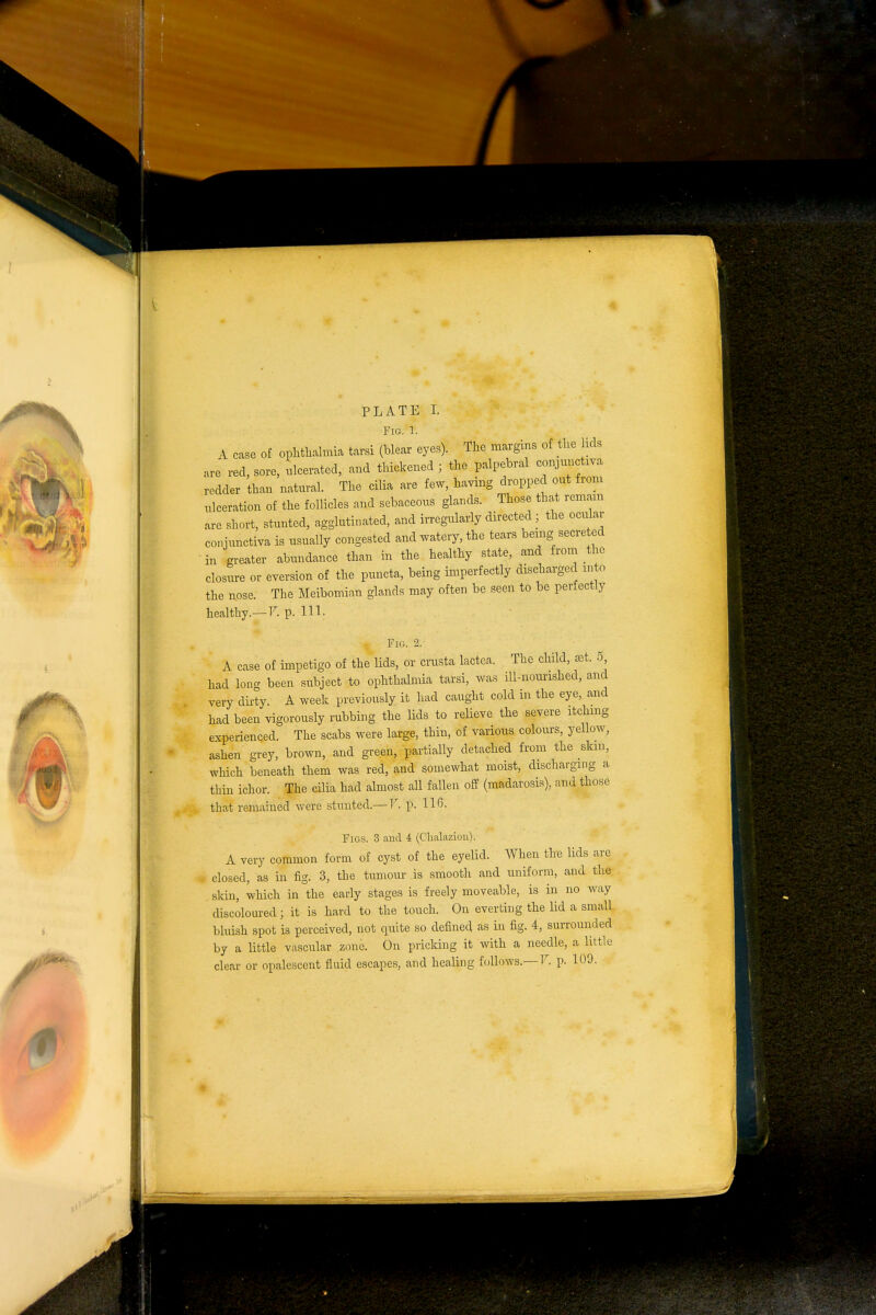 0 PLATE I. A case of ophthalmia tarsi (blear eyes). The margins of the lids are red, sore, ulcerated, and thickened ; the palpebral conjunctiva redder than natural. The cilia are few, having dropped out from ulceration of the follicles and sebaceous glands. Those that remain are short, stunted, agglutinated, and irregularly directed j the ocular conjunctiva is usually congested and watery, the tears being secreted in greater abundance than in the healthy state, and from the closure or eversion of the puncta, being imperfectly discharged into the nose. The Meibomian glands may often be seen to be perfectly Fig. 2. A case of impetigo of the lids, or crusta lactea. The child, set. 5 had long been subject to ophthalmia tarsi, was ill-nourished, and very dirty. A week previously it had caught cold in the eye, and had been vigorously rubbing the lids to relieve the severe itching experienced. The scabs were large, thin, of various colours, yellow, ashen grey, brown, and green, partially detached from the skm, which beneath them was red, and somewhat moist, discharging a thin ichor. The cilia had almost all fallen off (madarosis), and those that remained were stunted.— V. p. 116. Figs. 3 and 4 (Chalazion). A very common form of cyst of the eyelid. When the lids are closed, as in fig. 3, the tumour is smooth and uniform, and the skin, which in the early stages is freely moveable, is in no way discoloured • it is hard to the touch. On everting the lid a small bluish spot is perceived, not quite so defined as in fig. 4, surrounded by a little vascular zone. On pricking it with a needle, a little clear or opalescent fluid escapes, and healing follows.— V. p. 109.