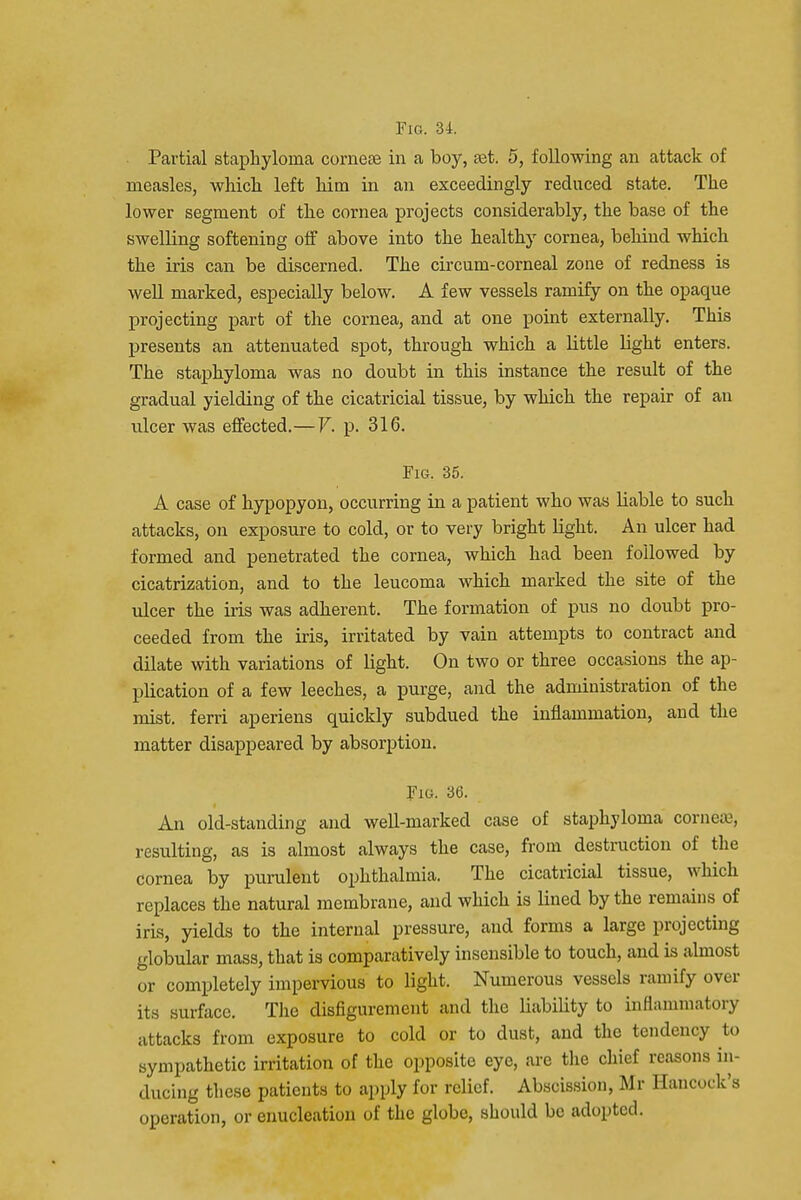 Partial staphyloma cornea? in a boy, aat. 5, following an attack of measles, which left him in an exceedingly reduced state. The lower segment of the cornea projects considerably, the base of the swelling softening off above into the healthy cornea, behind which the iris can be discerned. The circum-corneal zone of redness is well marked, especially below. A few vessels ramify on the opaque projecting part of the cornea, and at one point externally. This presents an attenuated spot, through which a little light enters. The staphyloma was no doubt in this instance the result of the gradual yielding of the cicatricial tissue, by which the repair of an ulcer was effected.—V. p. 316. Fig. 35. A case of hypopyon, occurring in a patient who was liable to such attacks, on exposure to cold, or to very bright light. An ulcer had formed and penetrated the cornea, which had been followed by cicatrization, and to the leucoma which marked the site of the ulcer the iris was adherent. The formation of pus no doubt pro- ceeded from the iris, irritated by vain attempts to contract and dilate with variations of light. On two or three occasions the ap- plication of a few leeches, a purge, and the administration of the mist, ferri aperiens quickly subdued the inflammation, and the matter disappeared by absorption. Fig. 36. An old-standing and well-marked case of staphyloma cornea', resulting, as is almost always the case, from destruction of the cornea by purulent ophthalmia. The cicatricial tissue, which replaces the natural membrane, and which is lined by the remains of iris, yields to the internal pressure, and forms a large projecting globular mass, that is comparatively insensible to touch, and is almost or completely impervious to light. Numerous vessels ramify over its surface. The disfigurement and the liability to inflammatory attacks from exposure to cold or to dust, and the tendency to sympathetic irritation of the opposite eye, are the chief reasons in- ducing these patients to apply for relief. Abscission, Mr Hancock's operation, or enucleation of the globe, should be adopted.