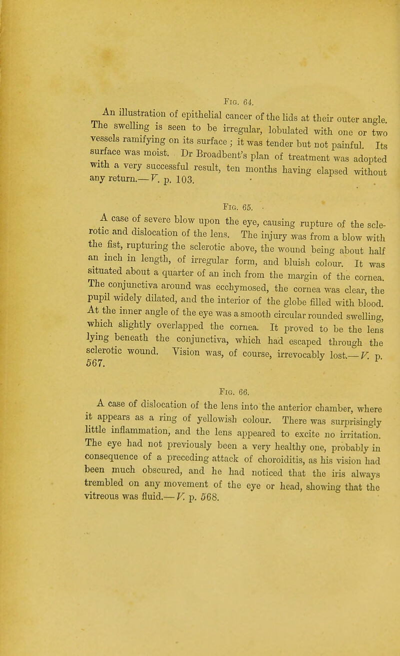 An illustration of epithelial cancer of the lids at their outer angle The swelling is seen to be irregular, lobulated with one or two vessels ramifying on its surface ; it was tender but not painful Its surface was moist. Dr Broadbent's plan of treatment was adopted with a very successful result, ten months having elapsed without any return.— V. p. 103. Fig. 65. ■ A case of severe blow upon the eye, causing rupture of the scle- rotic and dislocation of the lens. The injury was from a blow with the fist, rupturing the sclerotic above, the wound being about half an inch m length, of irregular form, and bluish colour. It was situated about a quarter of an inch from the margin of the cornea The conjunctiva around was ecchymosed, the cornea was clear, the pupil widely dilated, and the interior of the globe filled with blood. At the inner angle of the eye was a smooth circular rounded swelling which slightly overlapped the cornea. It proved to be the lens lying beneath the conjunctiva, which had escaped through the sclerotic wound. Vision was, of course, irrevocably lost — V p 567.  1 Fig. 66. A case of dislocation of the lens into the anterior chamber, where it appears as a ring of yellowish colour. There was surprisingly little inflammation, and the lens appeared to excite no irritation. The eye had not previously been a very healthy one, probably in consequence of a preceding attack of choroiditis, as his vision had been much obscured, and he had noticed that the iris always trembled on any movement of the eye or head, showing that the vitreous was fluid.— V. p. 568.