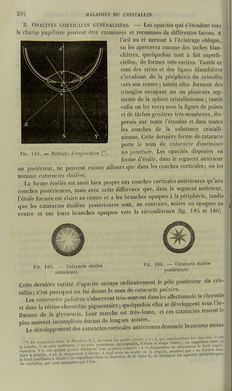 R. Opacités cokticai.ks cunéualisels. — Les opacités qui s'étendent vers le champ pupillaire peuvent ôtre examinées et reconnues de différentes façons. A l'œil nu et surtout à l'éclairage oblique, on les apercevra comme des taches blan- châtres, quelquefois tout à fait superfi- cielles, de formes très-variées. Tantôt ce sont des stries et des lignes blanchâtres s'irradiant de la périphérie du cristallin vers son centre ; tantôt elles forment des triangles occupant un ou plusieurs seg- ments de la sphère crislallinienne ; tantôt enfin on les verra sous la figure de points et de tâches grisâtres très-nombreux, dis- persés sur toute l'étendue et dans toutes les couches de la substance crislalli- nienne. Cette dernière forme de cataracte porte le nom de cataracte disséminée ou ponctuée. Les opacités disposées en forme d'étoile, dans le segment antérieur ou postérieur, ne peuvent exister ailleurs que dans les couches corticales; on les nomme cataractes étoilées. La forme étoilée est aussi bien propre aux couches corticales antérieures qu'aux couches postérieures, mais avec cette différence que, dans le segment antérieur, l'étoile formée est claire au centre et a les branches opaques à la périphérie, tandis que les cataractes étoilées postérieures sont, au contraire, noires ou opaques au centre et ont leurs branches opaques vers la circonférence (fig. 185 et 186). Fig. 181. — Méthode d'exploration (*). Fig. 185. — Cataracte étoilée antérieure. Fig. 186. — Cataracte étoilée postérieure. Cette dernière variété d'opacité occupe ordinairement le pôle postérieur du cris- tallin ; c'est pourquoi on lui donne le nom de cataracte polaire. Les cataractes polaires s'observent très-souvent dans les affections de la choro.de et dans la rétino-choroïdile pigmentaire ; quelquefois elles se développent sous I in- fluence de la glycosurie. Leur marche est très-lente, et ces cataractes restent le, nlus souvent incomplètes durant de longues années. Le développement des cataractes corticales antérieures demande beaucoup moins