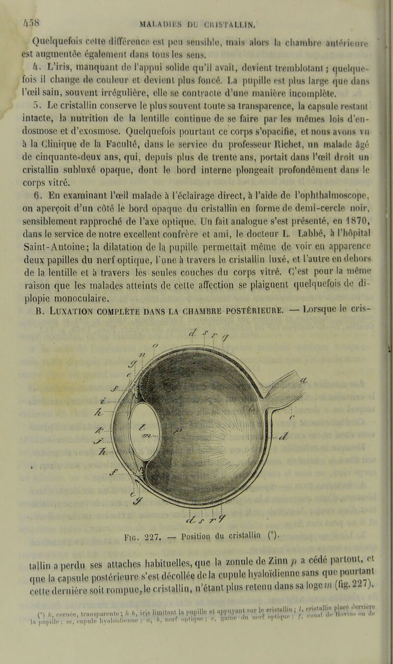 Quelquefois celte différence est peu sensible, mais alors la chambre antérieure est augmentée égaloment dans tons les sens. U. L'iris, manquant de l'appui solide qu'il avait, devient tremblotant ; quelque- ibis il change de couleur et devient plus foncé. La pupille est plus large que dans l'œil sain, souvent irrégulière, elle se contracte d'une manière incomplète. 5. Le cristallin conserve le plus souvent toute sa transparence, la capsule restant intacte, la nutrition de la lentille continue de se faire par les mêmes lois d'en- dosmose et d'exosmose. Quelquefois pourtant ce corps s'opacifie, et nous avons vu à la Clinique de la Faculté, dans le service du professeur Richet, un malade âgé de cinquante-deux ans, qui. depuis plus de trente ans, portait dans l'œil droit un cristallin subluxé opaque, dont le bord interne plongeait profondément dans le corps vitré. 6. En examinant l'œil malade à l'éclairage direct, à l'aide de l'ophthalmoscope, on aperçoit d'un côté le bord opaque du cristallin en forme de demi-cercle noir, sensiblement rapproché de l'axe optique. Un fait analogue s'est présenté, en 1870, dans le service de notre excellent confrère et ami, le docteur L. Labbé, à l'hôpital Saint-Antoine; la dilatation de la. pupille permettait même de voir en apparence deux papilles du nerf optique, l'une à travers le cristallin luxé, et l'autre en dehors de la lentille et à travers les seules couches du corps vitré. C'est pour la même raison que les malades atteints de celle affection se plaignent quelquefois de di- plopie monoculaire. B. Luxation complète dans la chambre postérieure. — Lorsque le ci i-- ,/ ./• /• V Fig. 227. — Position du cristallin (*). tallin a perdu ses attaches habituelles, que la zonule de Zinn a cédé partout, et que la capsule postérieure s'est décollée delà cupule hyaloïdienne sans que pourtant celle dernière soil roinpue}le cristallin, n'étant plus retenu dans sa loge m (ug. H 'h (•) k, cornée, tran.pnrento; h h, h\s limitai 1. ppiUs 91 <Mt«yan| sur 1, ^.MIU.; I. lapnpiilp; m, cupnle l.vnlMuienne ; n, b, nerf optique; r, Ifhtne .1 >r «pH<pi< h