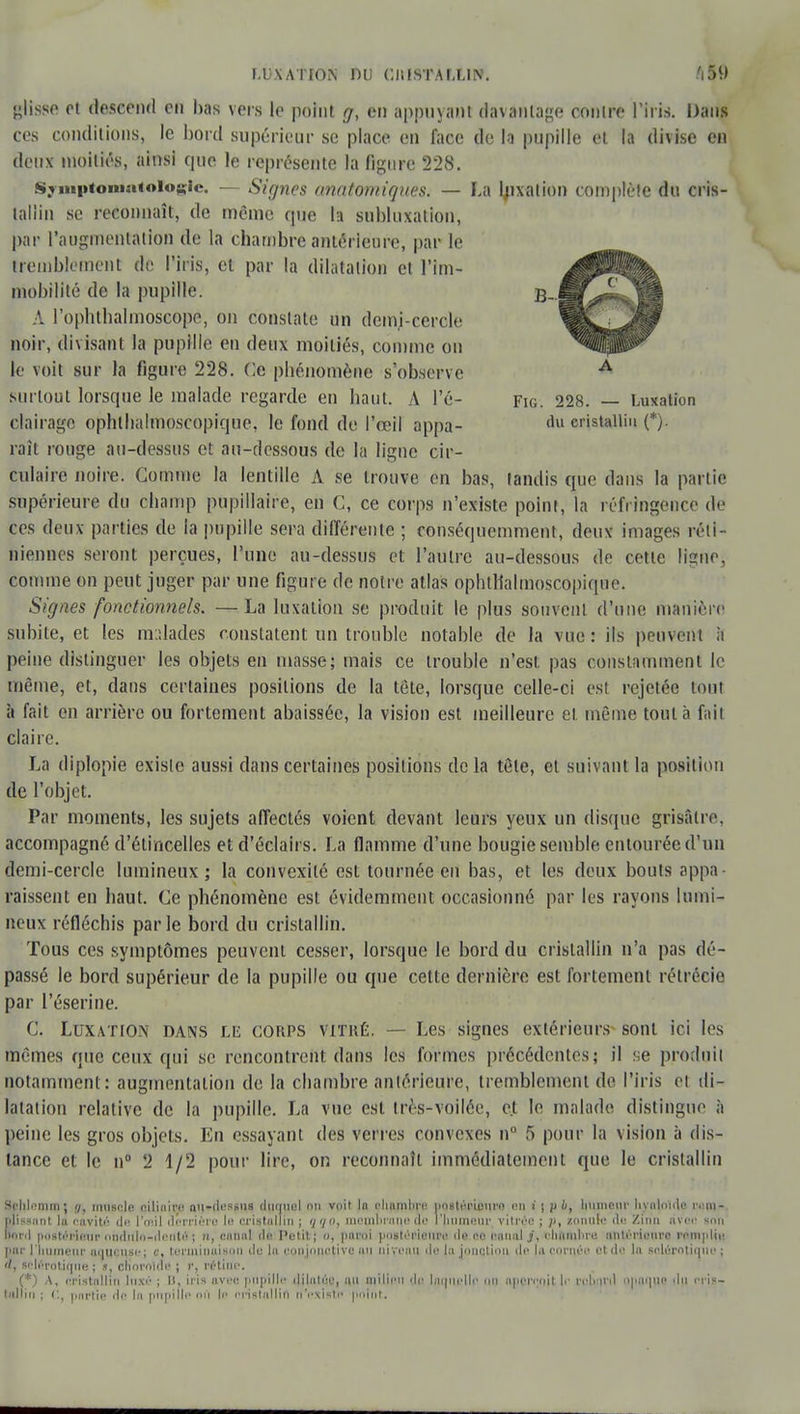 glisse et descend en bas vers le point g, en appuyant davantage contre l'iris. Dans ces conditions, le boni supérieur se place en face de la pupille et la divise en deux moitiés, ainsi que le représente la figure 228. SymptQUiaioIogte. — Signes unatomiques. — La fixation complète du cris- tallin se reconnaît, de même que la subluxation, par l'augmentation de la chambreantêriéore, par le tremblement de l'iris, et par la dilatation et l'im- mobilité de la pupille. B_. A l'oplitbalmoscope, on constate un demi-cercle noir, divisant la pupille en deux moitiés, comme on le voit sur la figure 228. Ce phénomène s'observe mu tout lorsque le malade regarde en haut. A l'é- fig. 228. — Luxation clairage ophihalmoscopiquc, le fond de l'œil oppa- 1,11 cristallin (*). raît rouge au-dessus et an-dessous de la ligne cir- culaire noire. Gomme la lentille A se trouve en bas, tandis que dans la partie supérieure du champ pupillaire, en G, ce corps n'existe point, la réfringence de ces deux parties de la pupille sera différente ; ronséquemment, deux images réti- niennes seront perçues, l'une au-dessus et l'autre au-dessous de cette ligne, comme on peut juger par une figure de notre atlas ophtîialmoscopique. Signes fonctionnels. —La luxation se produit le plus souvent d'une manière subite, et les malades constatent un trouble notable de la vue : ils peuvent à peine distinguer les objets en masse; mais ce trouble n'est pas constamment le même, et, dans certaines positions de la tête, lorsque celle-ci est rejetée toul a fait en arrière ou fortement abaissée, la vision est meilleure et même tout à fail claire. La diplopie existe aussi dans certaines positions delà tête, et suivant la position de l'objet. Par moments, les sujets affectés voient devant leurs yeux un disque grisâtre, accompagné d'étincelles et d'éclairs. La flamme d'une bougie semble entourée d'un demi-cercle lumineux; la convexité est tournée en bas, et les deux bouts appa- raissent en haut. Ge phénomène est évidemment occasionné par les rayons lumi- neux réfléchis par le bord du cristallin. Tous ces symptômes peuvent cesser, lorsque le bord du cristallin n'a pas dé- passé le bord supérieur de la pupille ou que cette dernière est fortement rétrécie par l'éserine. C. Luxation dans le corps vitré. — Les signes extérieurs- sont ici les mêmes que ceux qui se rencontrent dans les formes précédentes; il se produit notamment : augmentation de la chambre antérieure, tremblement de l'iris et di- latation relative de la pupille. La vue est très-voilée, et le malade distingue à peine les gros objets. En essayant des verres convexes n° 5 pour la vision à dis- tance et le n° 2 1/2 pour lire, on reconnaît immédiatement que le cristallin Srldonim; n, muscle oilinire au-dessus duquel n» voit la chambre poslérlcurn en ï | p b, liiimeui' hvnloule iviii- ffisgnnt lu cavité de l'œil derrière I» cristallin ; 350, membrane de l'humeur vitrée ; p, lonuie de Zinp avec «en boni postérieur nwlnio-donté ; n, canal de Petit ; a, paroi postérieure de ce canal j, chambre antérieure remplie par l'humeur aqueuse; c, terminaison de la conjonctive au niveau de la punition de l.i cornée et de la sclérotique ; sclérotique; .1, choroïde ; r, rétine. (*) A, cristallin luxé ; H, iris avec pupille dilalée, au milieu de laquelle ou aperçoit, le rphurd opaque du eris- tdllin ; e, partie de la pupille on le cristallin rf'pxlsw point.