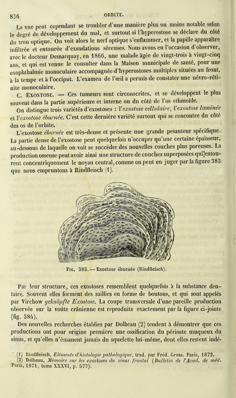 La vue peut cependant se troubler d'une manière plus ou moins notable selon le degré de développement du mal, et surtout si l'hyperostose se déclare du côté du trou optique. On voit alors le nerf optique s'enflammer, et la papille apparaître infiltrée et entourée d'exsudations séreuses. Nous avons eu l'occasion d'observer, avec le docteur Demarquay,en 1866, une malade âgée de vingt-trois à vingt-cinq ans, et qui est venue le consulter dans la Maison municipale de santé, pour une exo'phthalmie monoculaire accompagnée d'hyperostoses multiples situées au front, à la tempe et à l'occiput. L'examen de l'œil a permis de constater une névro-réti- nite monoculaire. C. EXOSTOSE. — Ces tumeurs sont circonscrites, et se développent le plus souvent dans la partie supérieure et interne ou du côté de l'os elhmoïde. On distingue trois variétés d'exostoses : Vexostose cellulaire, ïexostose laminée et Vexostose éburnée. C'est cette dernière variété surtout qui se rencontre du côté des os de l'orbite. Vexostose éburyiée est très-dense et présente une grande pesanteur spécifique. La partie dense de l'exostose peut quelquefois n'occuper qu'une certaine épaisseur, au-dessous de laquelle on voit se succéder des nouvelles couches plus poreuses. La production osseuse peut avoir ainsi une structure de couches superposées qui'entou- reot concentriquement le noyau central, comme on peut en juger par la figure 38a que nous empruntons à Rindfleisch (1). FiG, 383. — Exostose éburnée (Rindfleisch). Par leur structure^ ces exostoses ressemblent quelquefois à la substance den- taire. Souvent elles forment des saillies en forme de boutons, et qui sont appelés par Virchow geknôpfte Exostose. La coupe transversale d'une pareille production observée sur la voûte crânienne est reproduite exactement par la figure ci-jointe (fig. 384). Des nouvelles recherches établies par Dolbeau (2) tendent à démontrer que ces productions ont pour origine première une ossification du périoste muqueux du sinus, et qu'elles n'émanent jamais du squelette lui-même, dont elles restent indé- (1) Rindfleisch, Eléments d'histologie pathologique, Irad. par Fréd. Gross. Paris, 1872. (2) Dolbeau, Mémoire sur les exostoses du sinus frontal {Bulletin de l'Acad, de méd. Paris, 1871, tome XXXVI, p. 577).