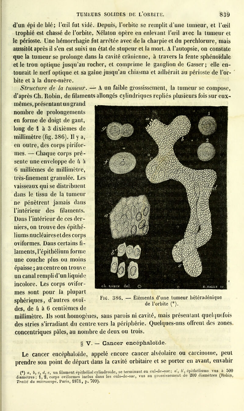 d'un épi de blé; l'œil fut vidé. Depurs, l'orbilc se remplit d'une tumeur, et l'œil Irophié est chassé de l'orbite. Nélaton opère en enlevant l'œil avec la tumeur et le périoste. Une hémorrhagie fut arrêtée avec de la charpie et du perchlorure, mais aussitôt après il s'en est suivi un état de stupeur et la mort. A l'autopsie, on constate que la tumeur se prolonge dans la cavité crânienne, à travers la fente sphénoïdale elle trou optique jusqu'au rocher, et couipiime le ganglion de Casser; elle en- tourait le nerf optique et sa gaine jusqu'au chiasma et adhérait au périoste de l'or- bite et à la dure-mère. Structure de la tumeur. —• A un faible grossissement, la tumeur se compose, d'après Ch. Robin, de filaments allongés cyhndriqucs repliés plusieurs fois sur eux- mêmes, présentant un grand nombre de prolongements en forme de doigt de gant, long de 1 à 3 dixièmes de millimètre (fig. 386). Il y a, en outre, des corps pirifor- mes. — Chaque corps pré- sente une enveloppe de l\ à 6 millièmes de miUimètre, très-finement granulée. Les vaisseaux qui se distribuent dans le tissu de la tumeur ne pénètrent jamais dans l'intérieur des filamenis. Dans l'intérieur de ces der- niers, on trouve des épithé- liums nucléaires et des corps oviformes. Dans certains fi- laments, l'épithélium forme une couche plus ou moins épaisse ; au centre on trouve un canal rempli d'un liquide incolore. Les corps ovifor- mes sont pour la plupart sphériques, d'autres ovoï- des, de 4 à 6 centièmes de millimètre. Ils sont homogènes, sans parois ni cavité, mais préseniant quei(iuefois des stries s'irradiant du centre vers la périphérie. Quelques-uns offrent des zones concentriques pâles, au nombre de deux ou trois. § V. — Cancer encéphaloïde. Le cancer encéphaloïde, appelé encore cancer alvéolaire ou carcinome, peut prendre son point de départ dans la cavité orbitaire et se porter en avant, envahir (*) a, h, c, d, e, un filament épilbéllalcyliudroïde, se terminaut eu cul-de-sac; a', b' épithéliums vus à 500 diamètres; 1,2, corps oviformes inclus dans les culs-de-sac, vus au çrossissemeot de 200 diamètres (Robm, Traité du microscojie. Paris, 1871, p. 709). FiG. 386. Éléments d'une tumeur hétéradénique de l'orbite (*).